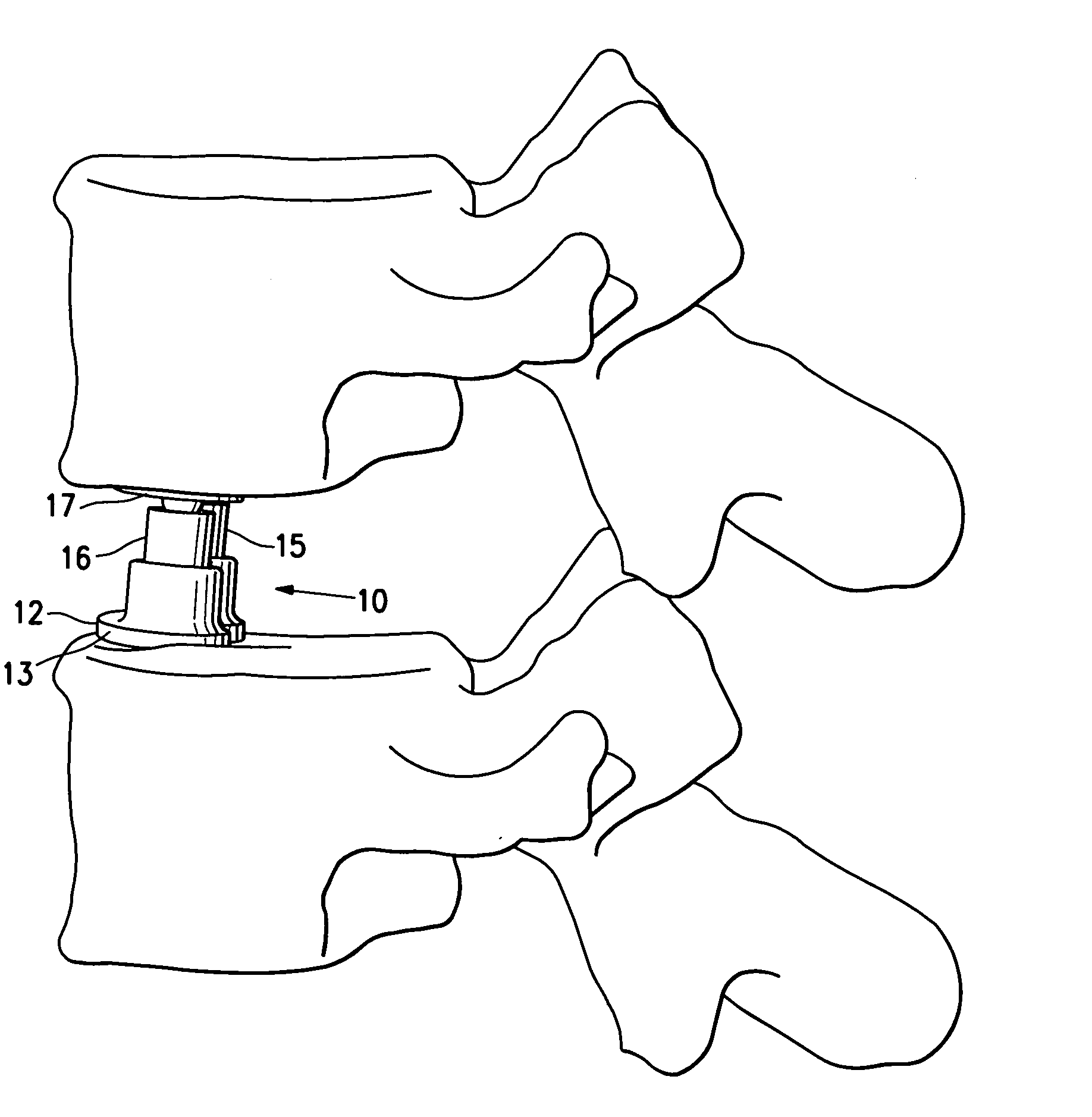 Spinal Implant with expandable fixation