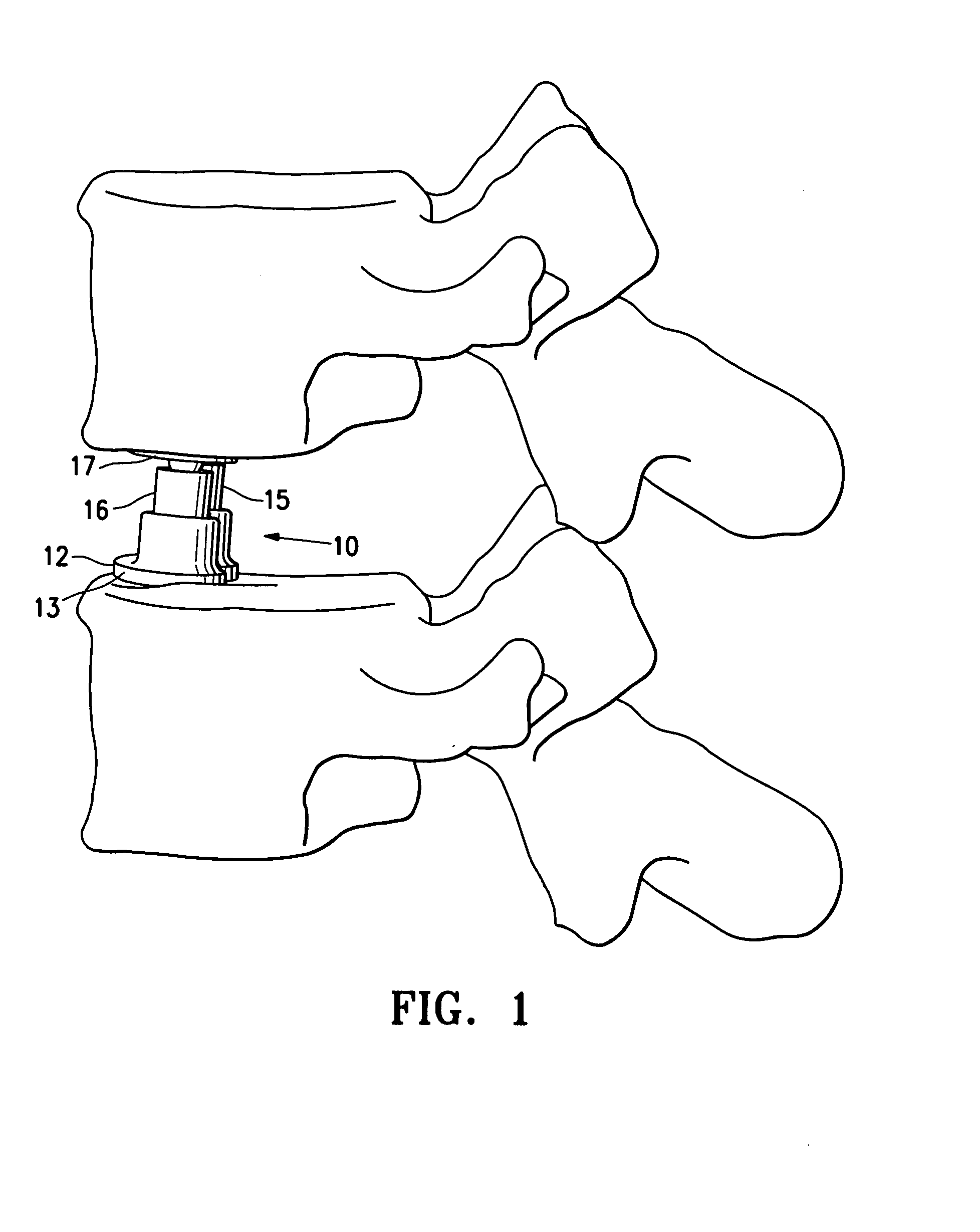 Spinal Implant with expandable fixation