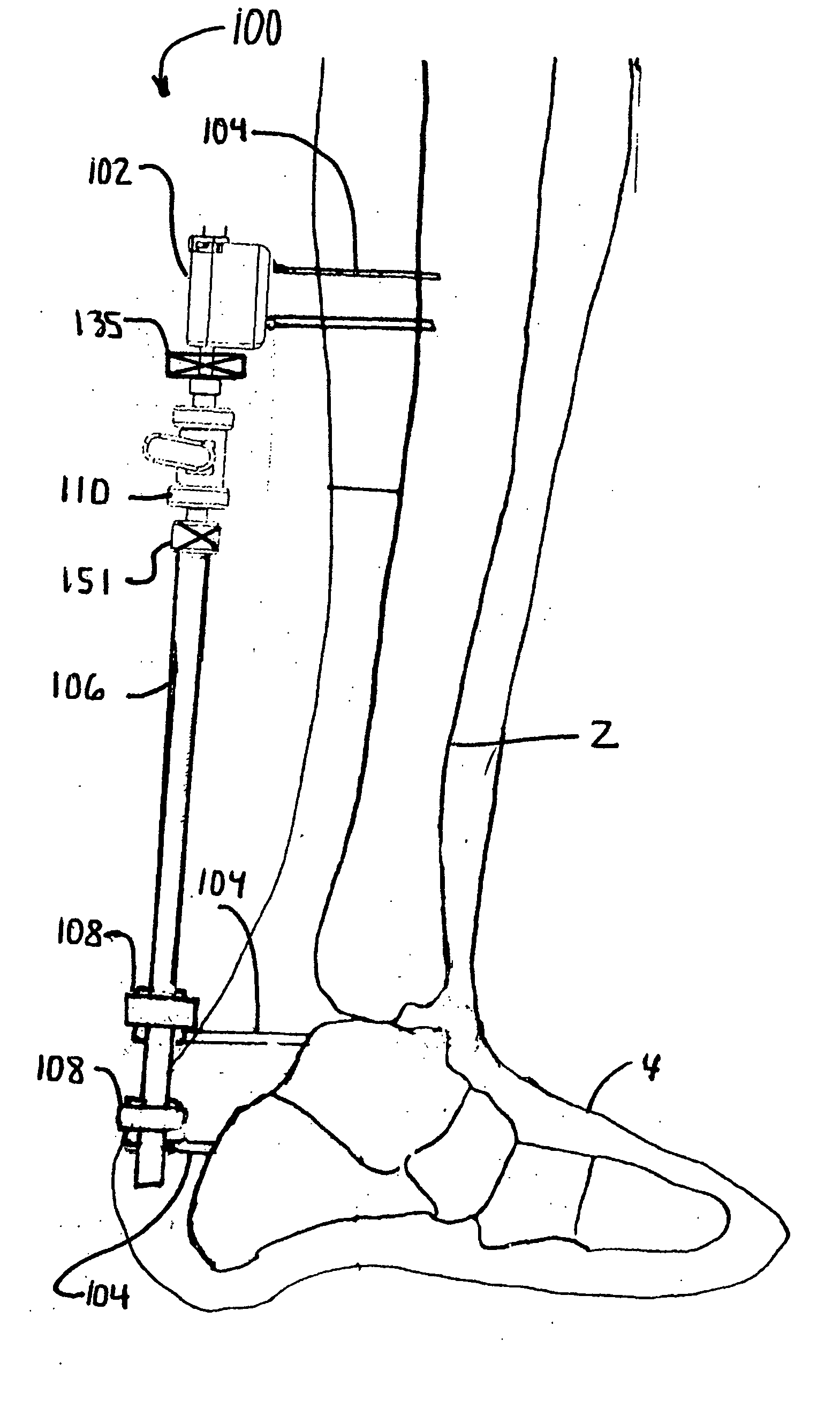 Trauma joint, external fixator and associated method