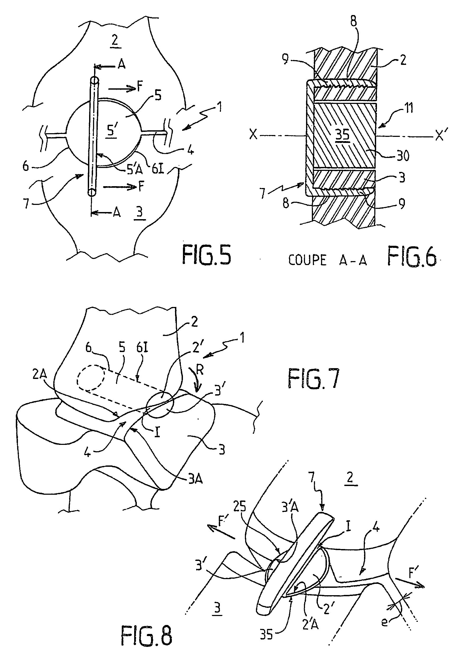 Fixation implant for a bone graft within a joint for the purpose of ensuring arthrodesis of the joint