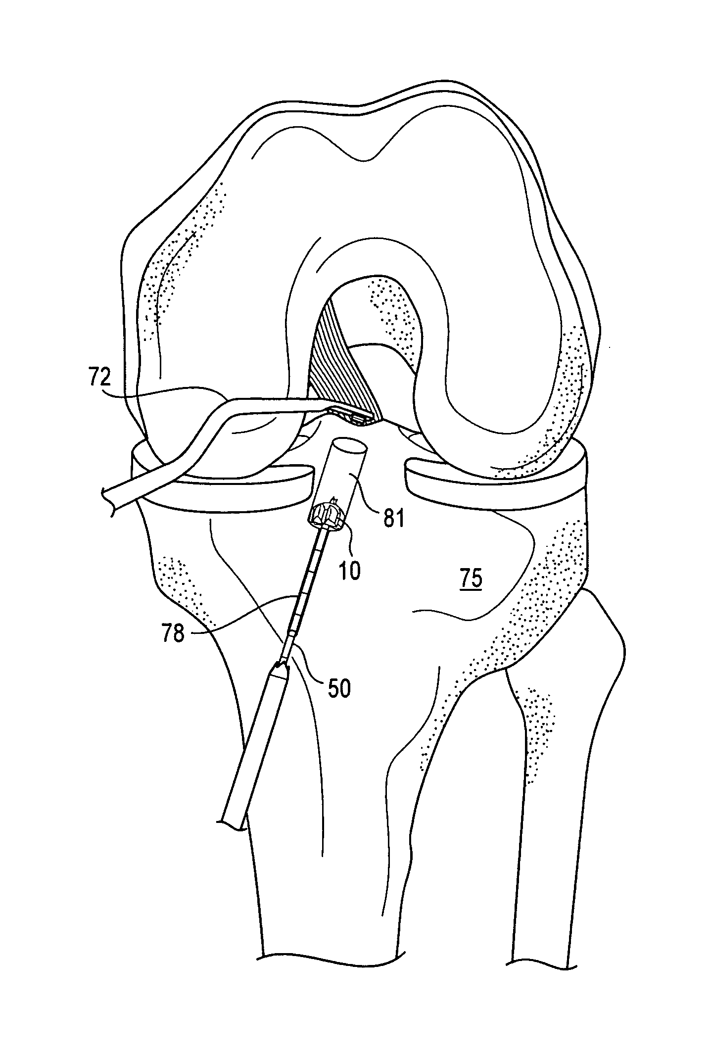 Method and apparatus for ACL reconstruction using retrograde cutter