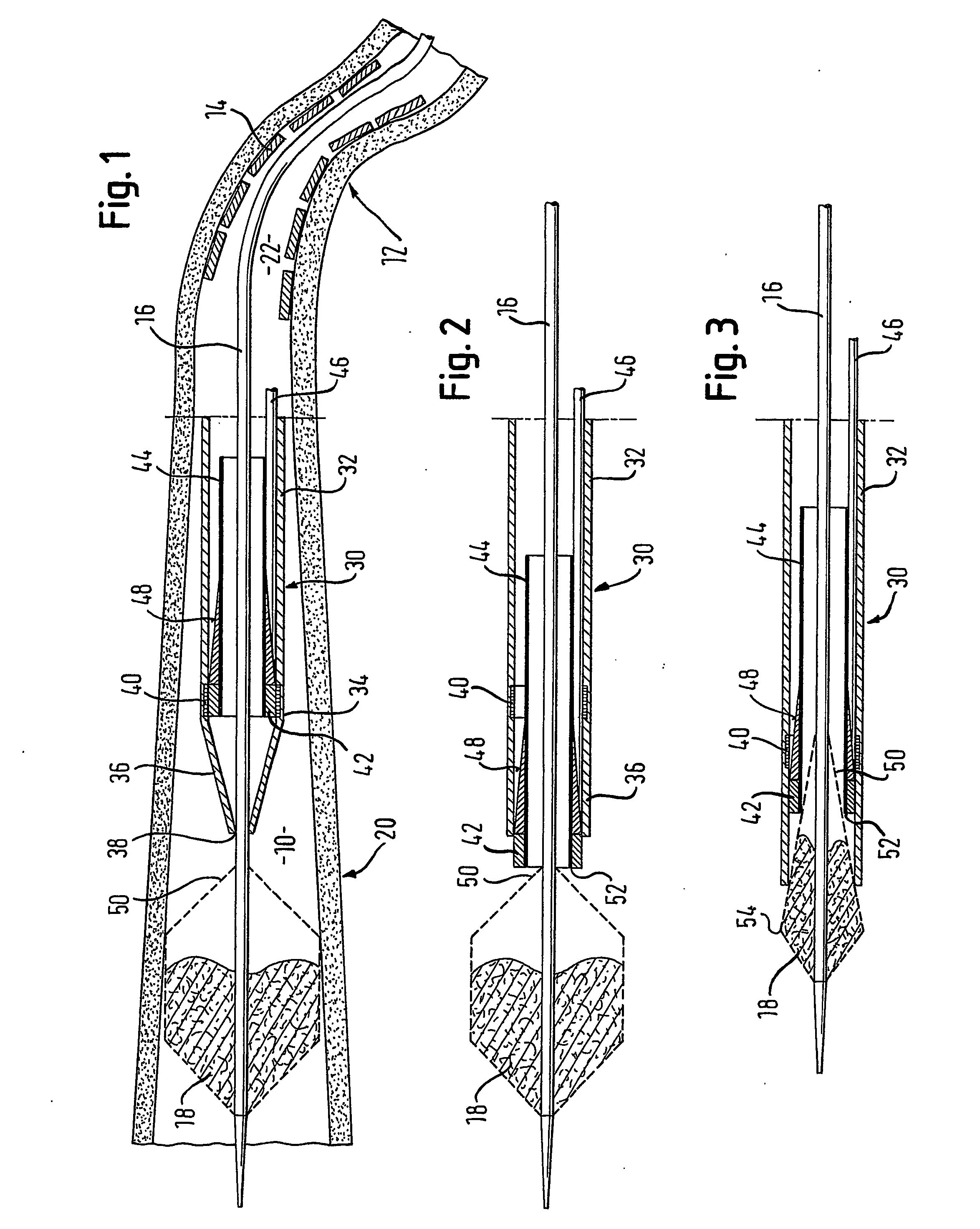 Retrieval catheter