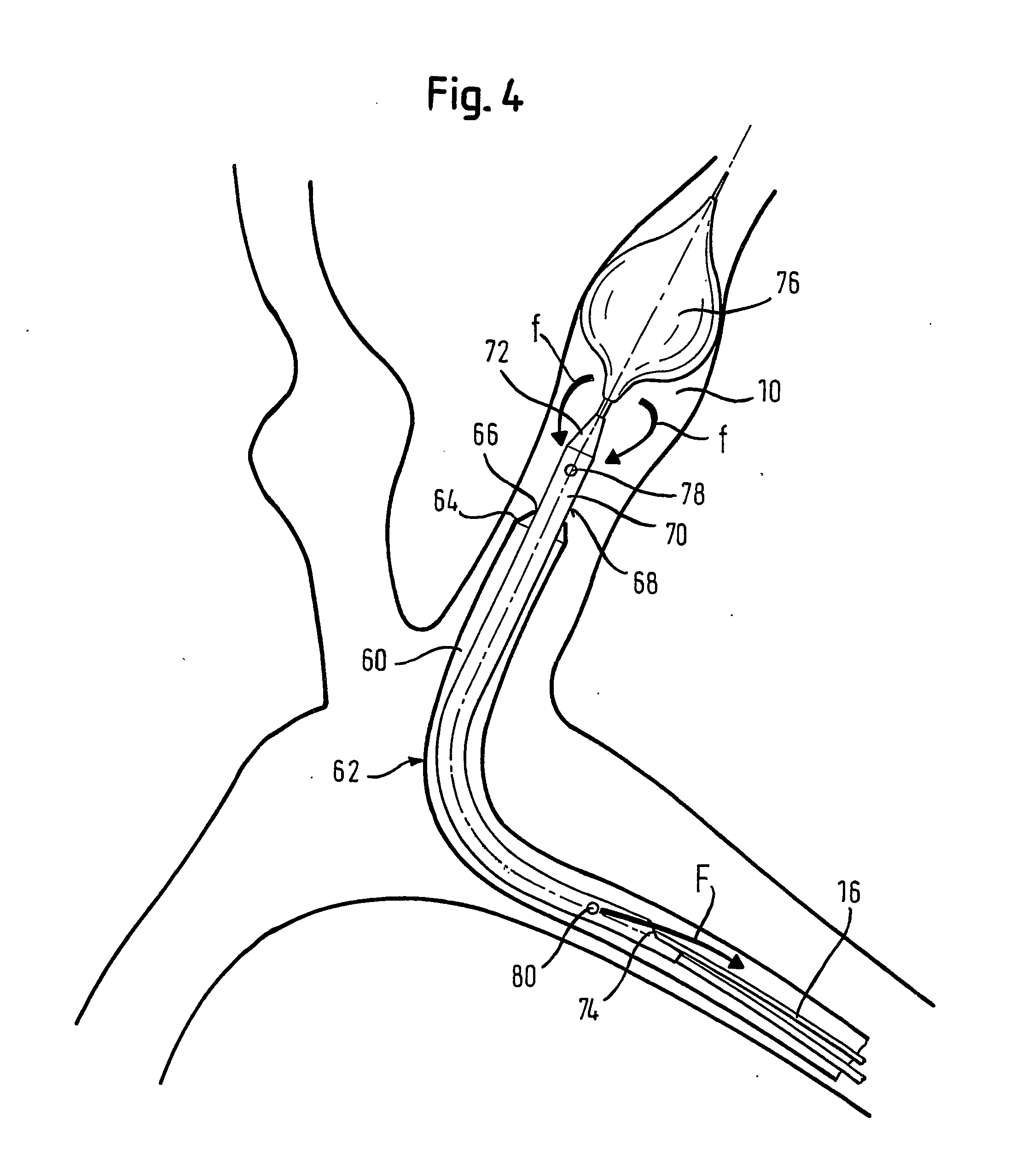 Retrieval catheter