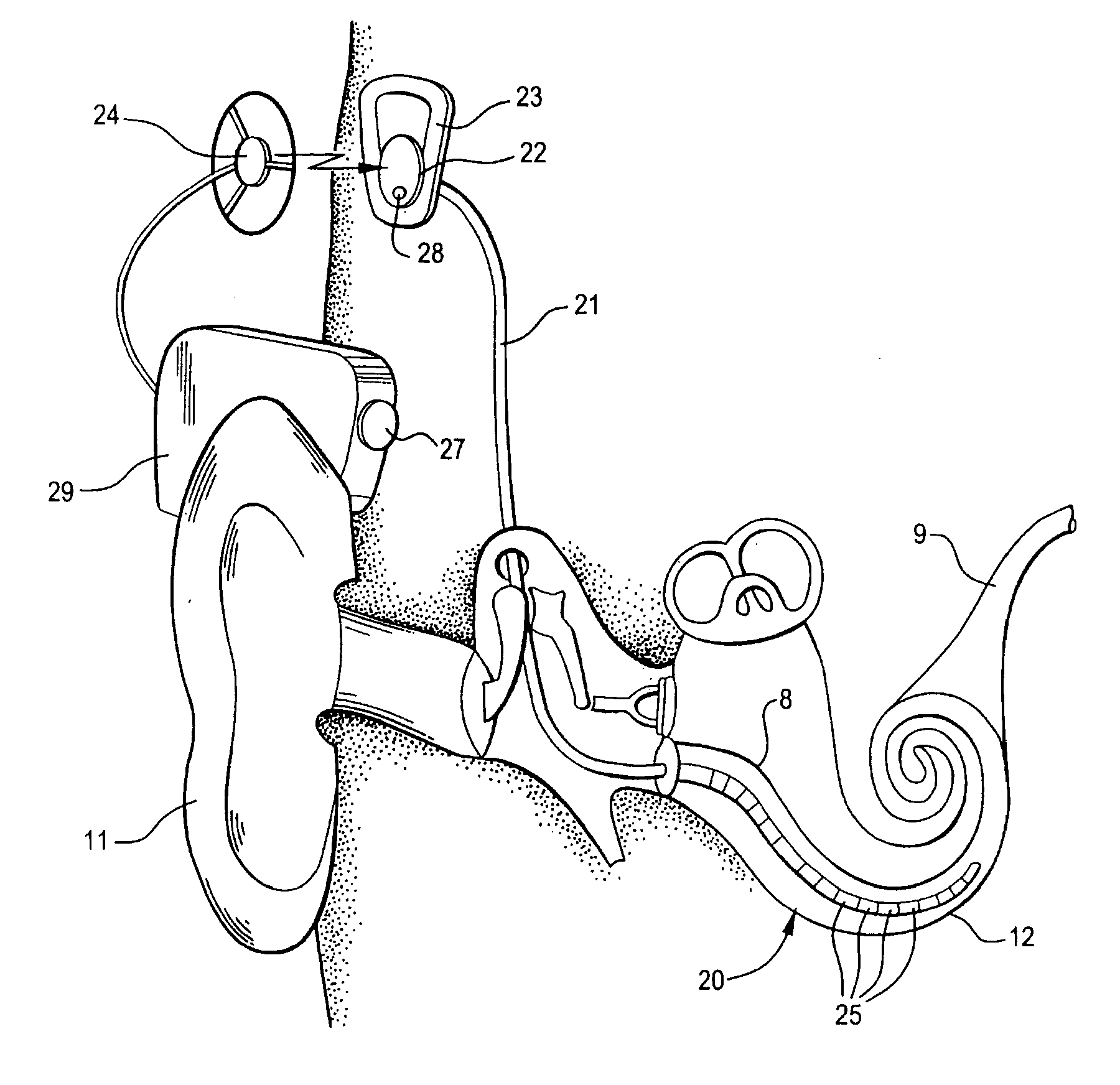 Combined stimulation for auditory prosthesis