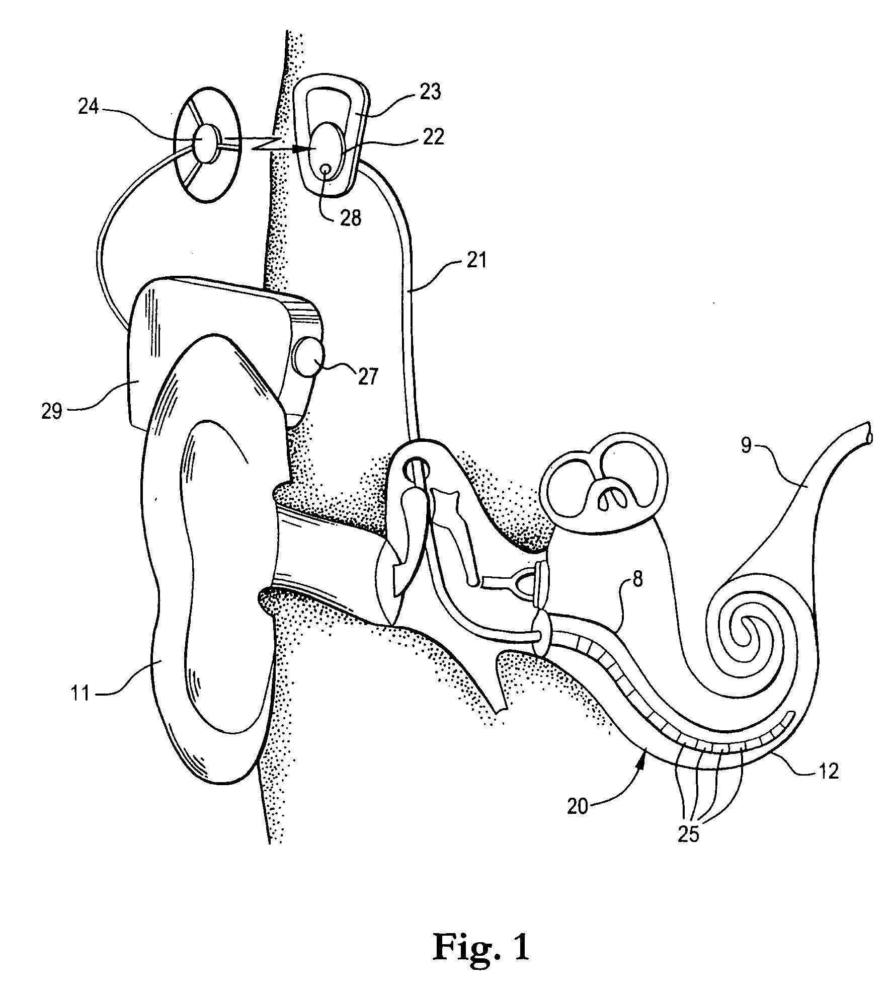 Combined stimulation for auditory prosthesis