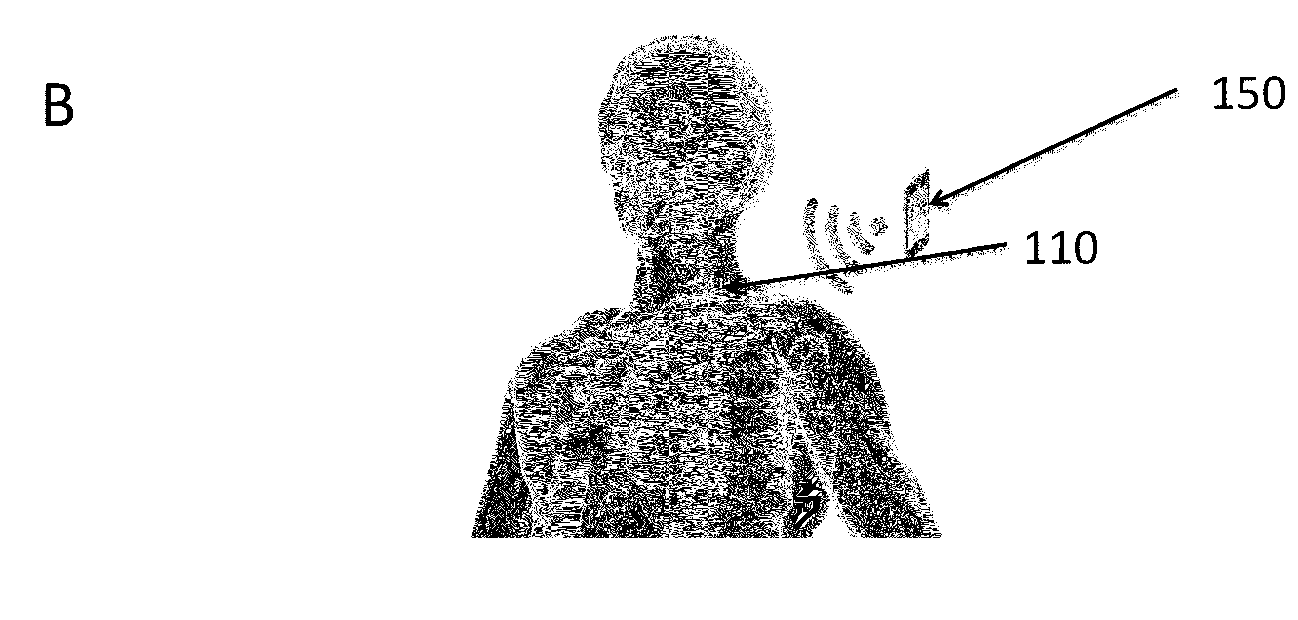 Device and method for interfering with sympathetic chain signaling for attenuating hot flashes, post-traumatic stress disorder, pain and dysautonomia