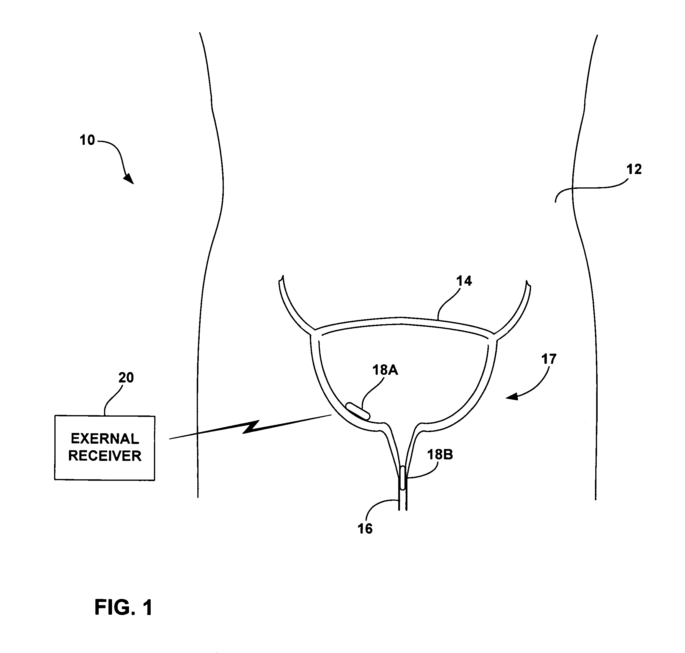 Implantable urinary tract monitor