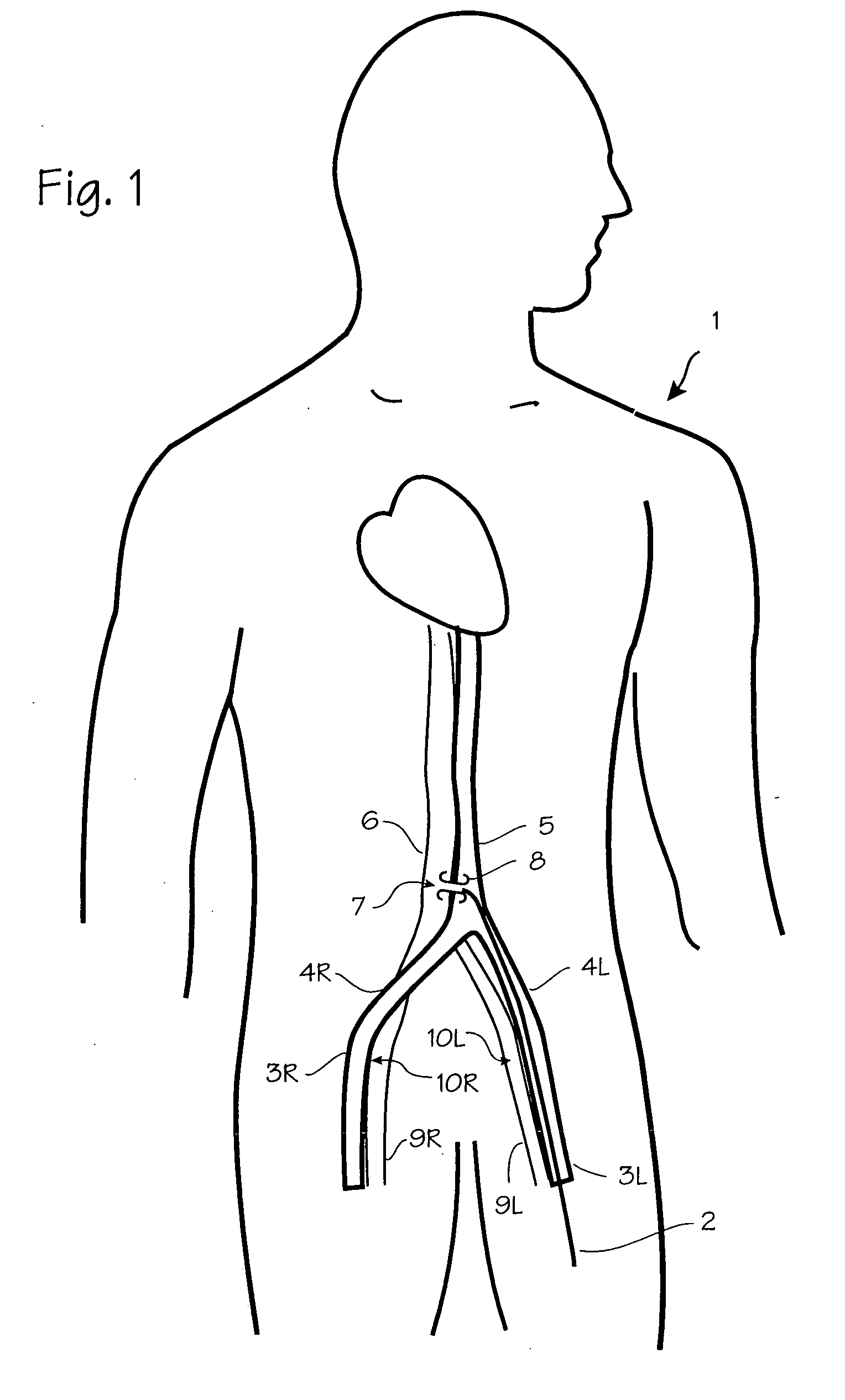 Device and method for establishing an artificial arterio-venous fistula