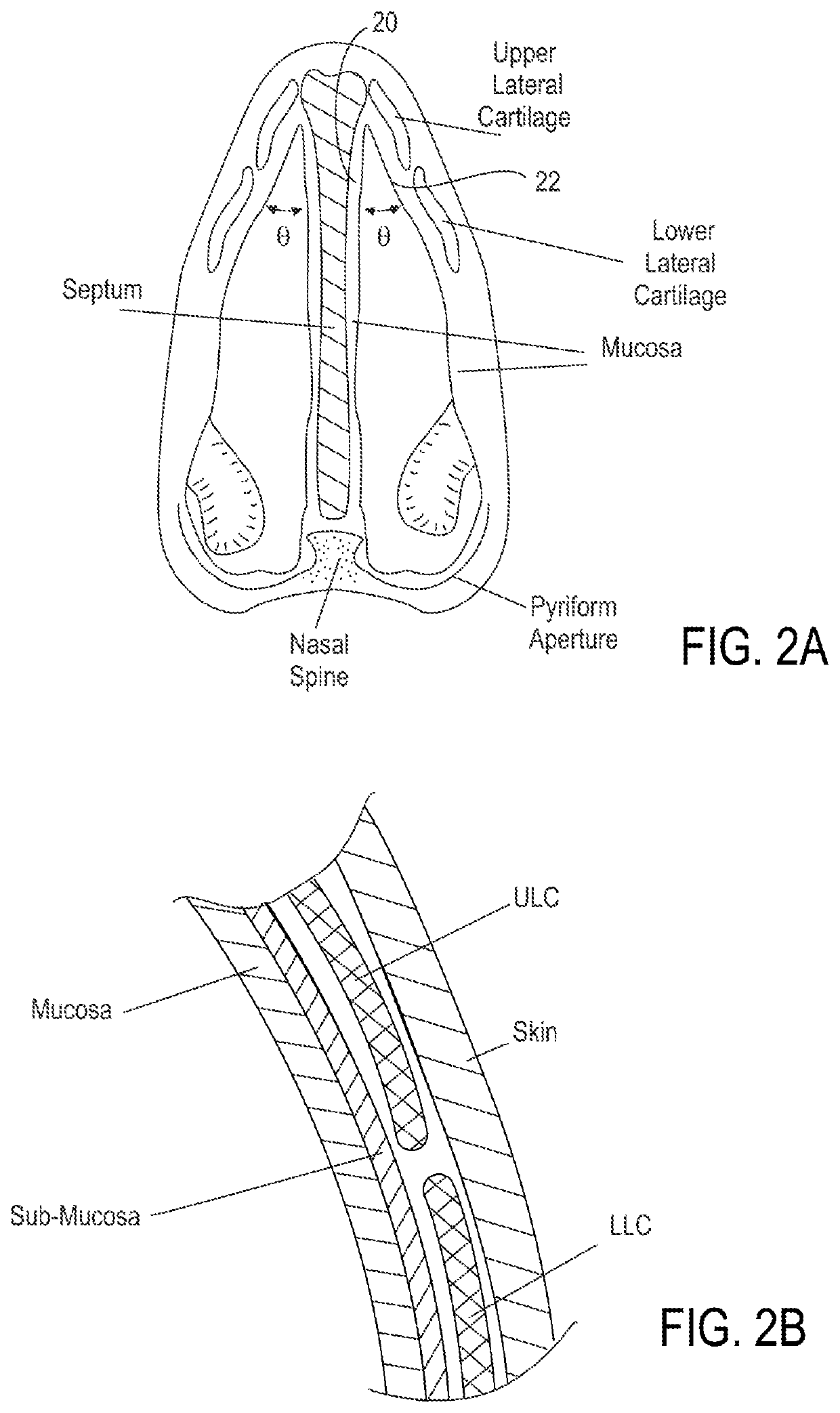 Methods and devices to treat nasal airways