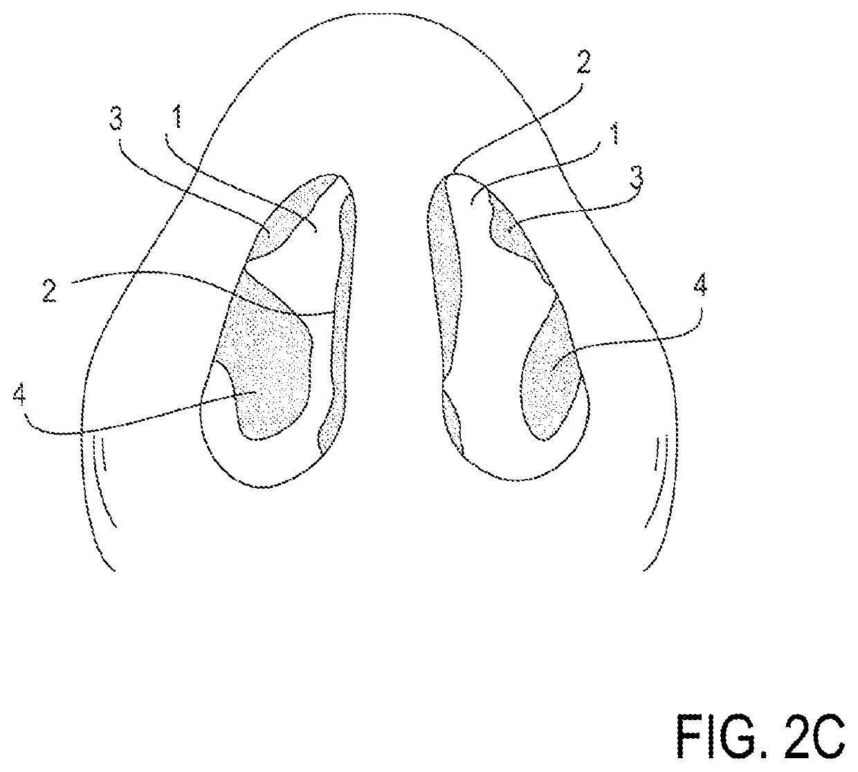 Methods and devices to treat nasal airways