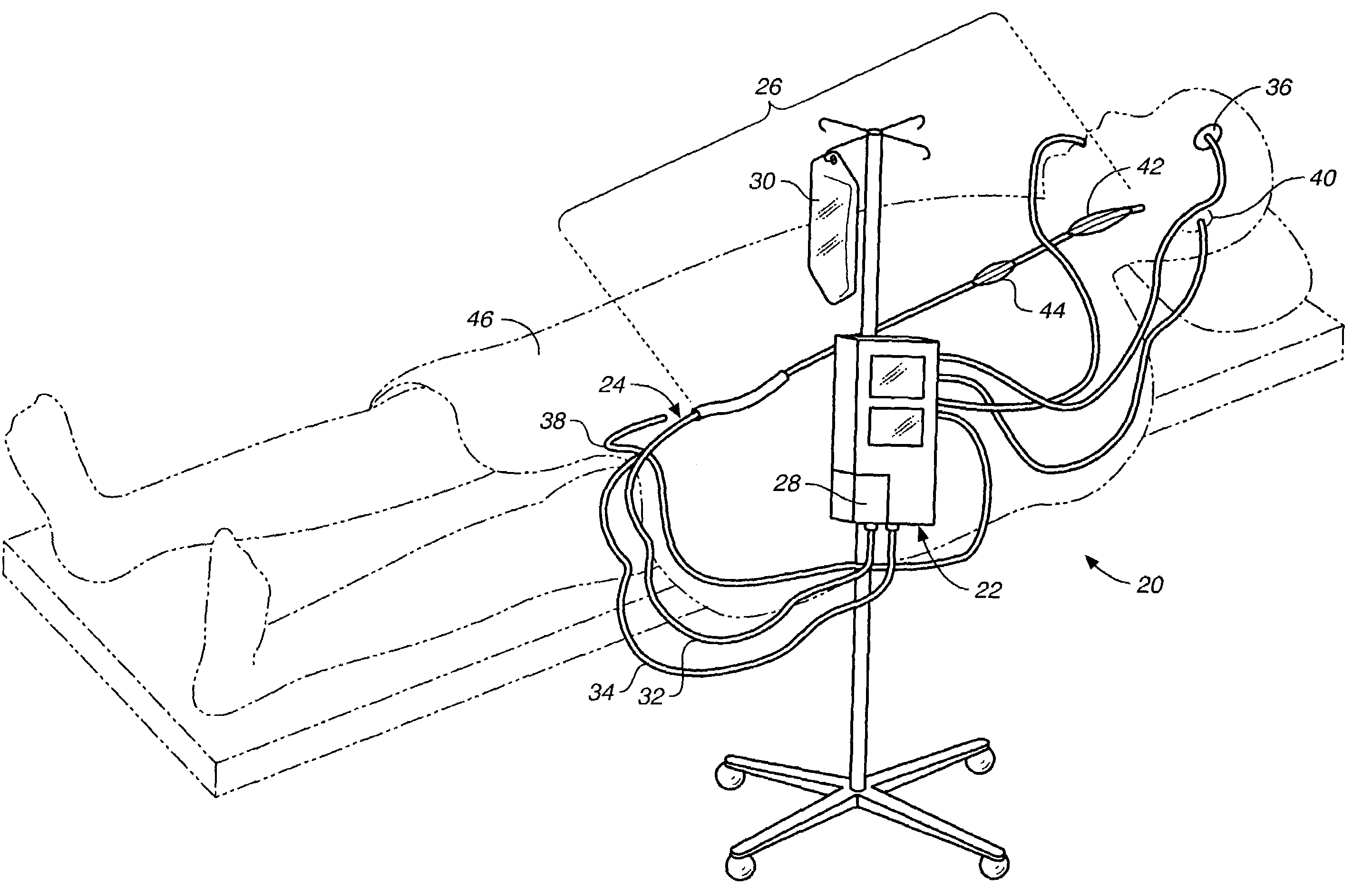 Method and system for control of a patient's body temperature by way of transluminally insertable heat exchange catheter