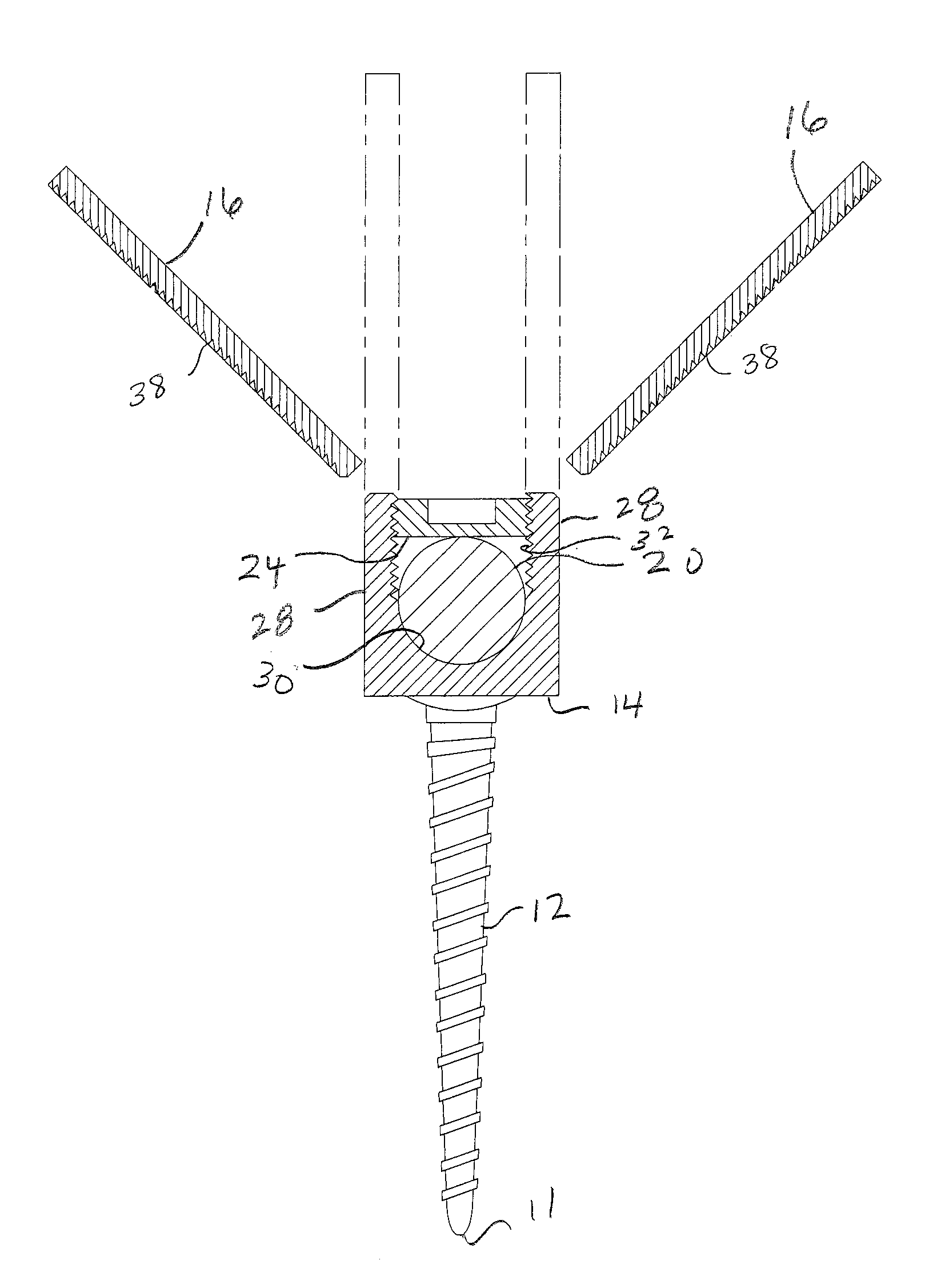 Screw and rod fixation system