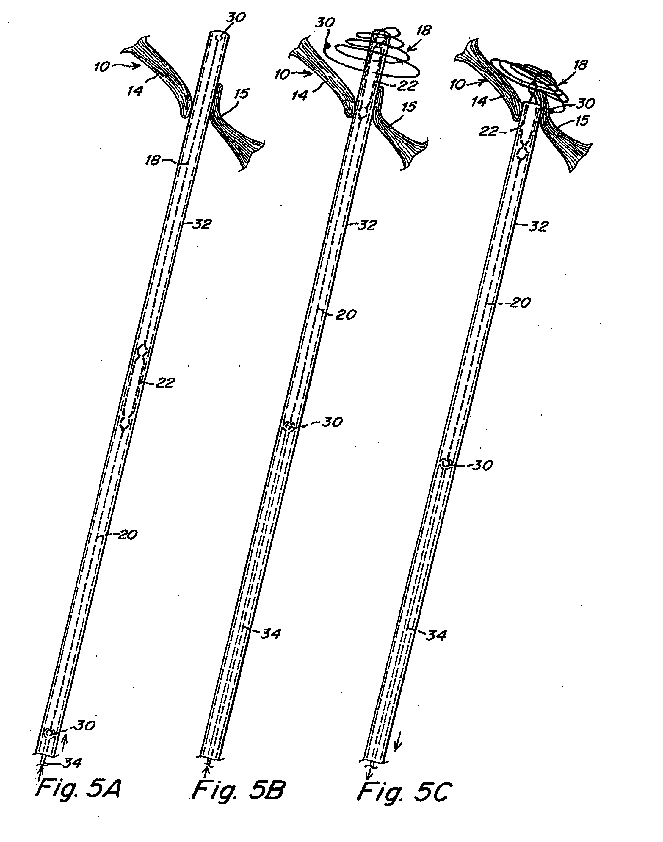 Double spiral patent foramen ovale closure clamp