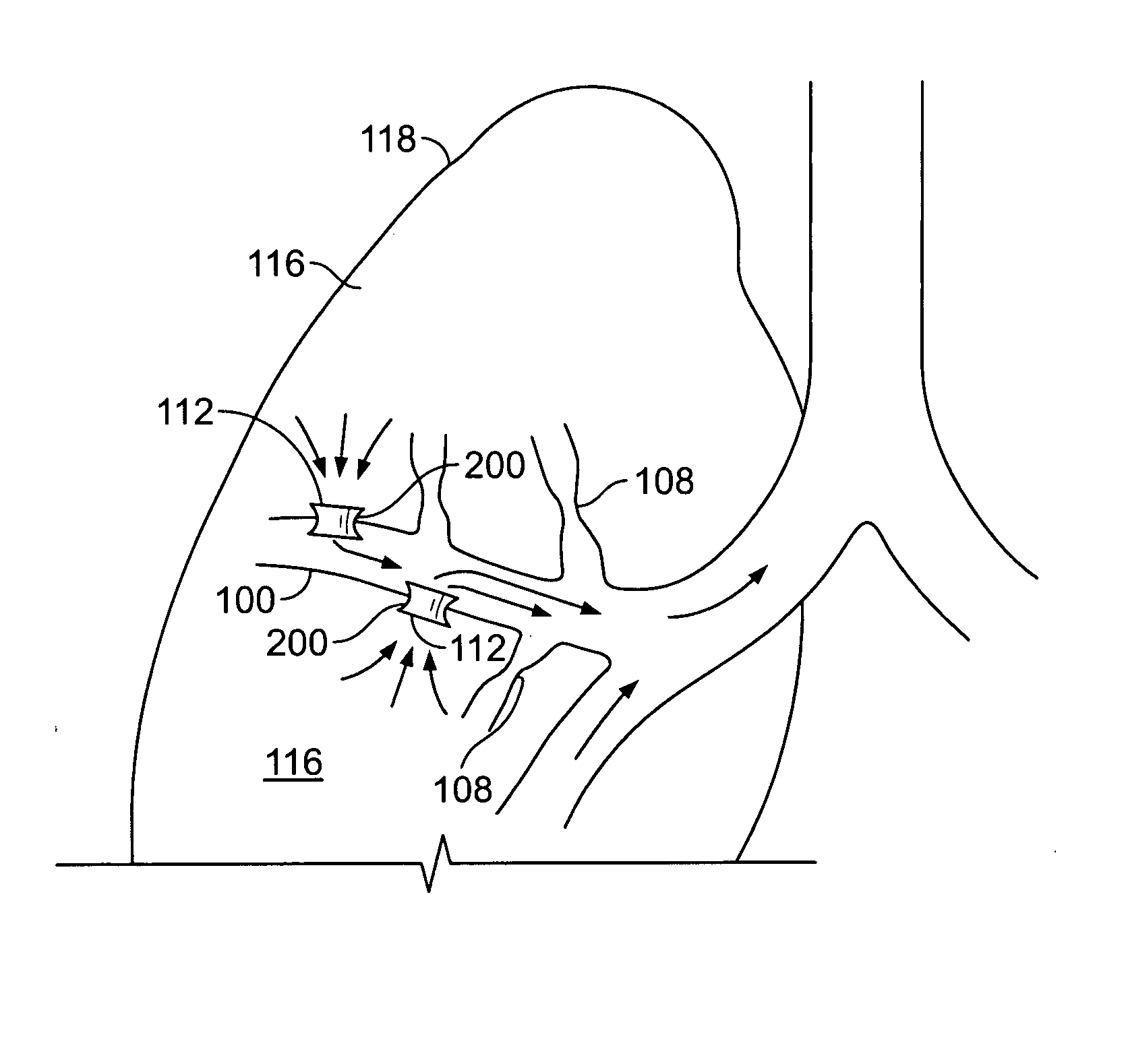 Devices for maintaining patency of surgically created channels in tissue