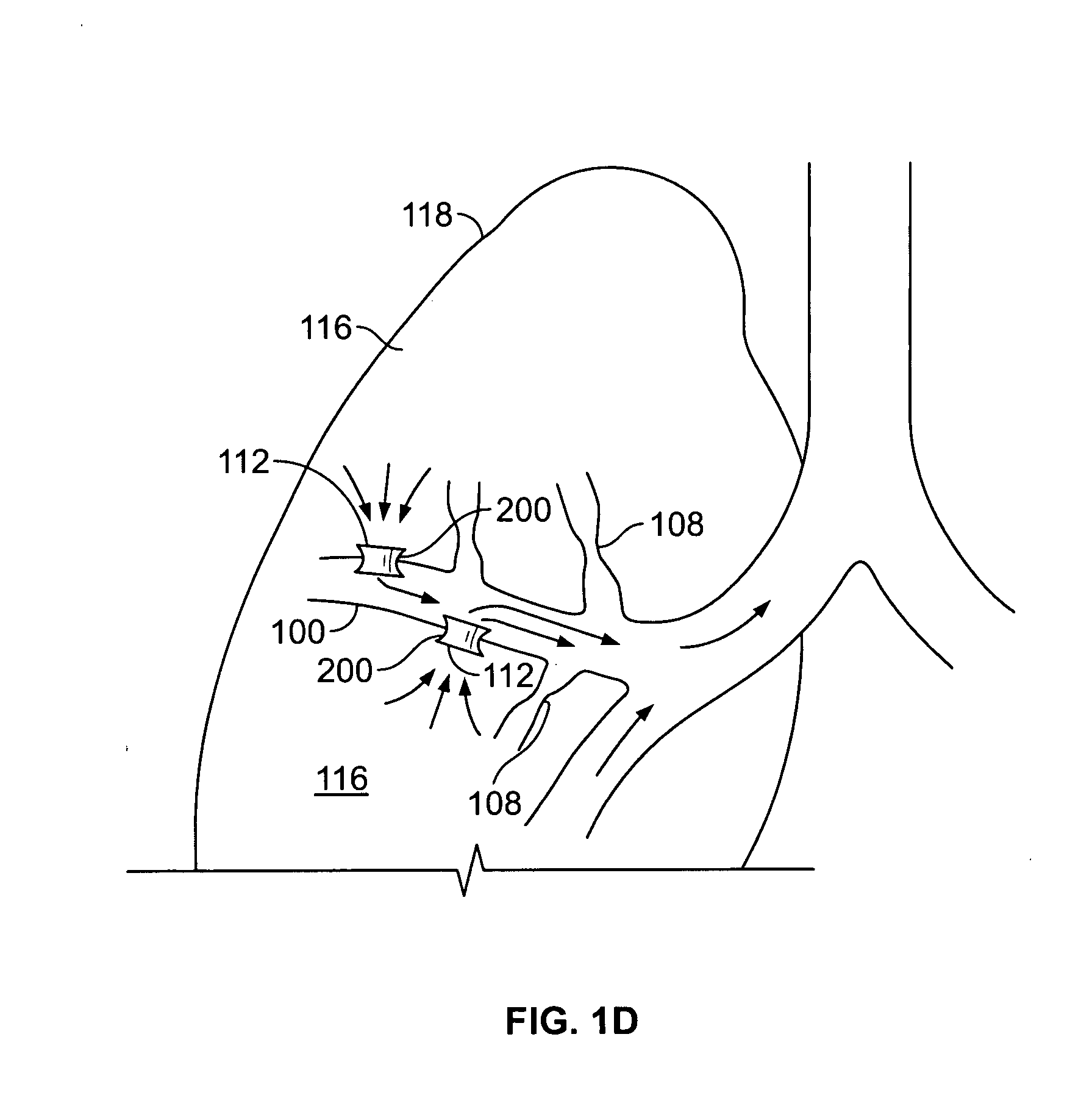 Devices for maintaining patency of surgically created channels in tissue