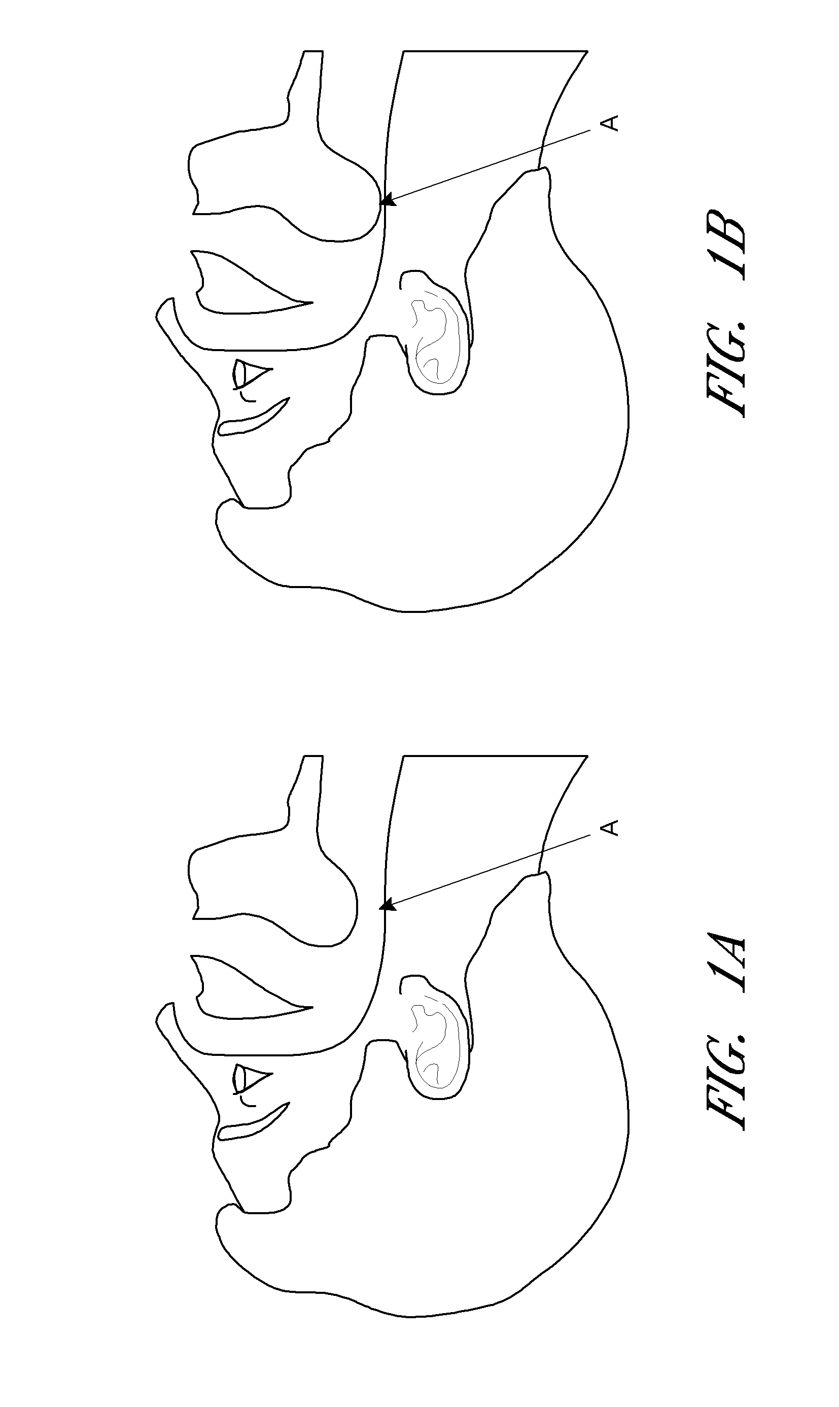 Sleep apnea device