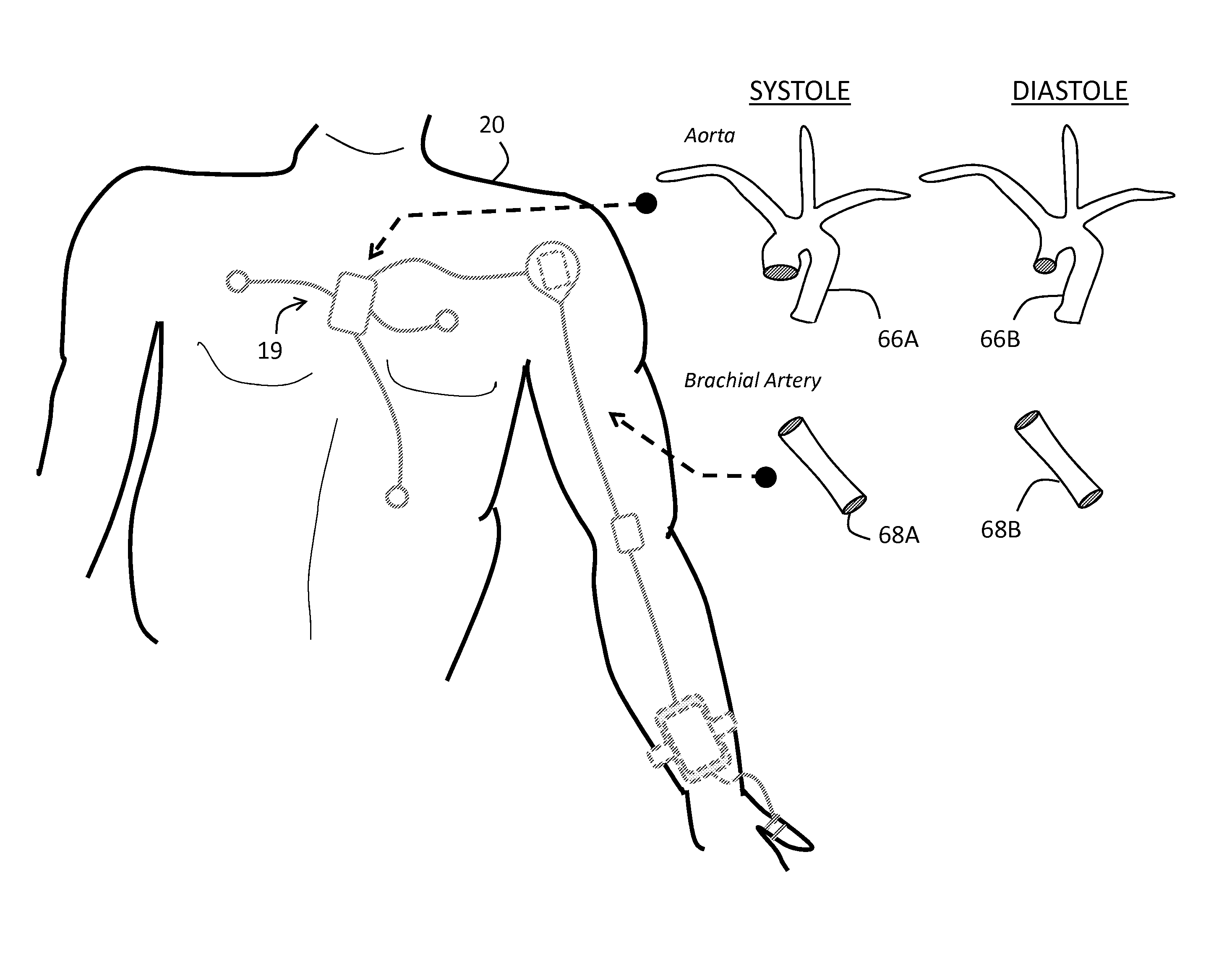 Body-worn system for continuous, noninvasive measurement of cardiac output, stroke volume, cardiac power, and blood pressure