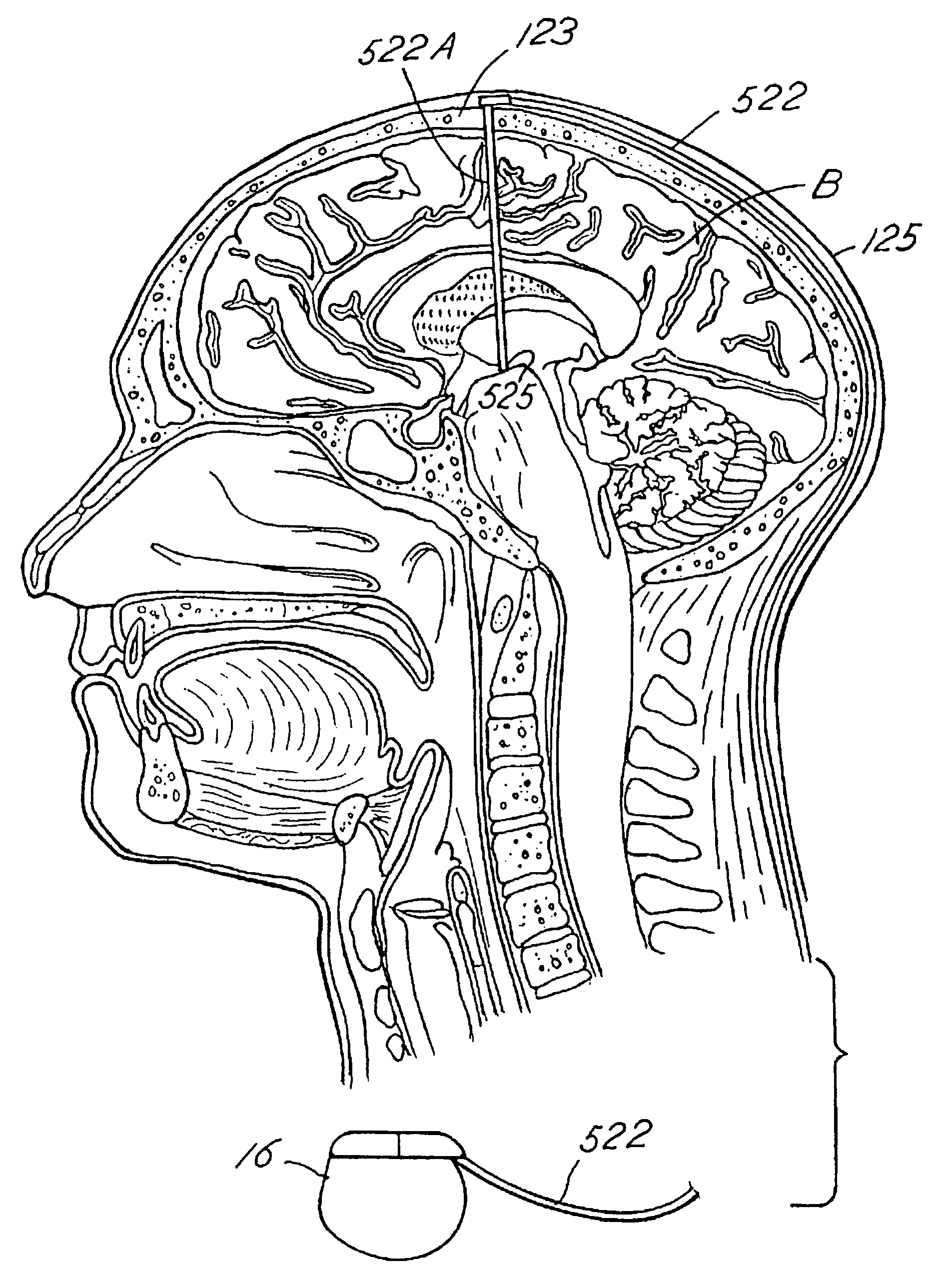 Inducing neurogenesis within a human brain