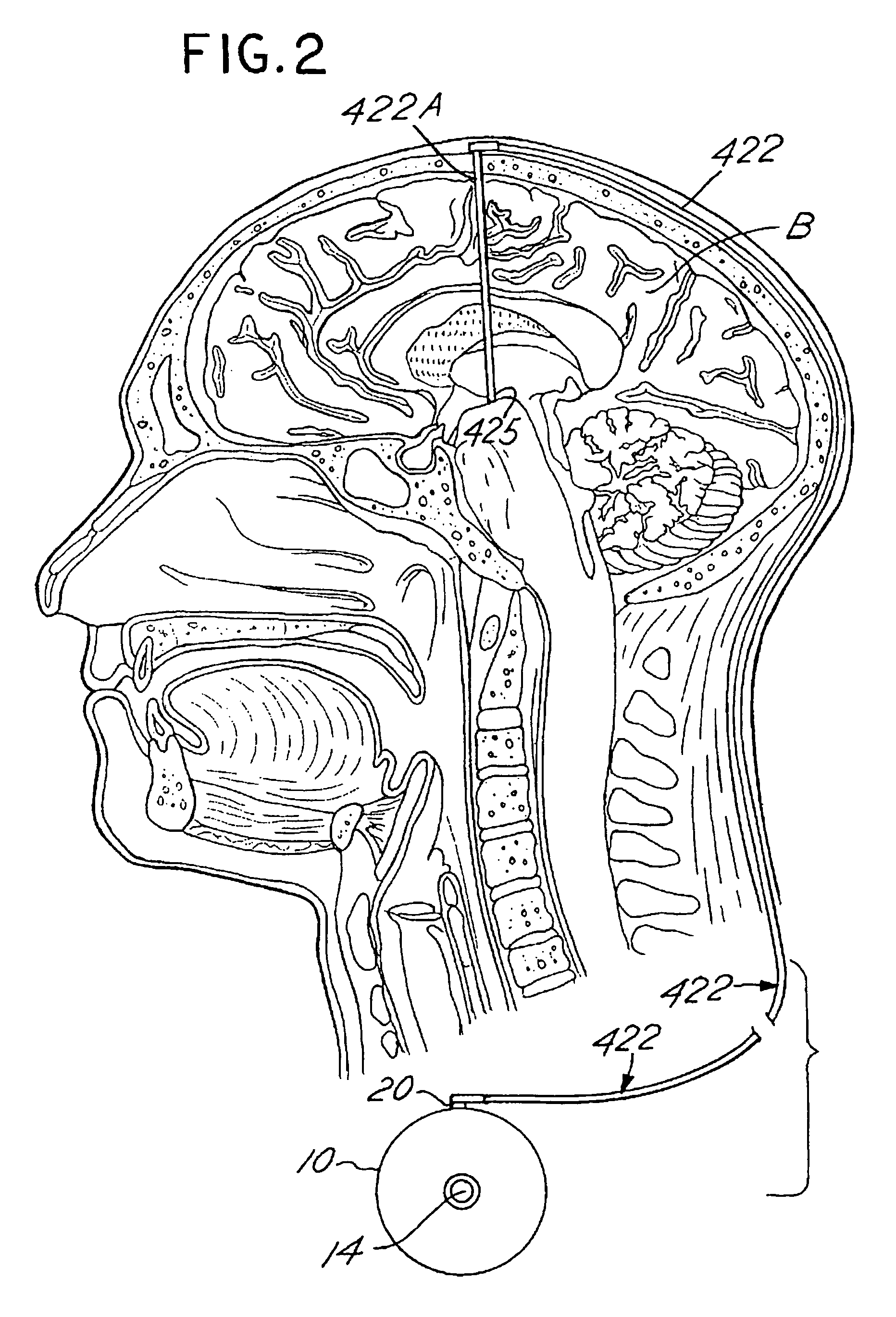 Inducing neurogenesis within a human brain