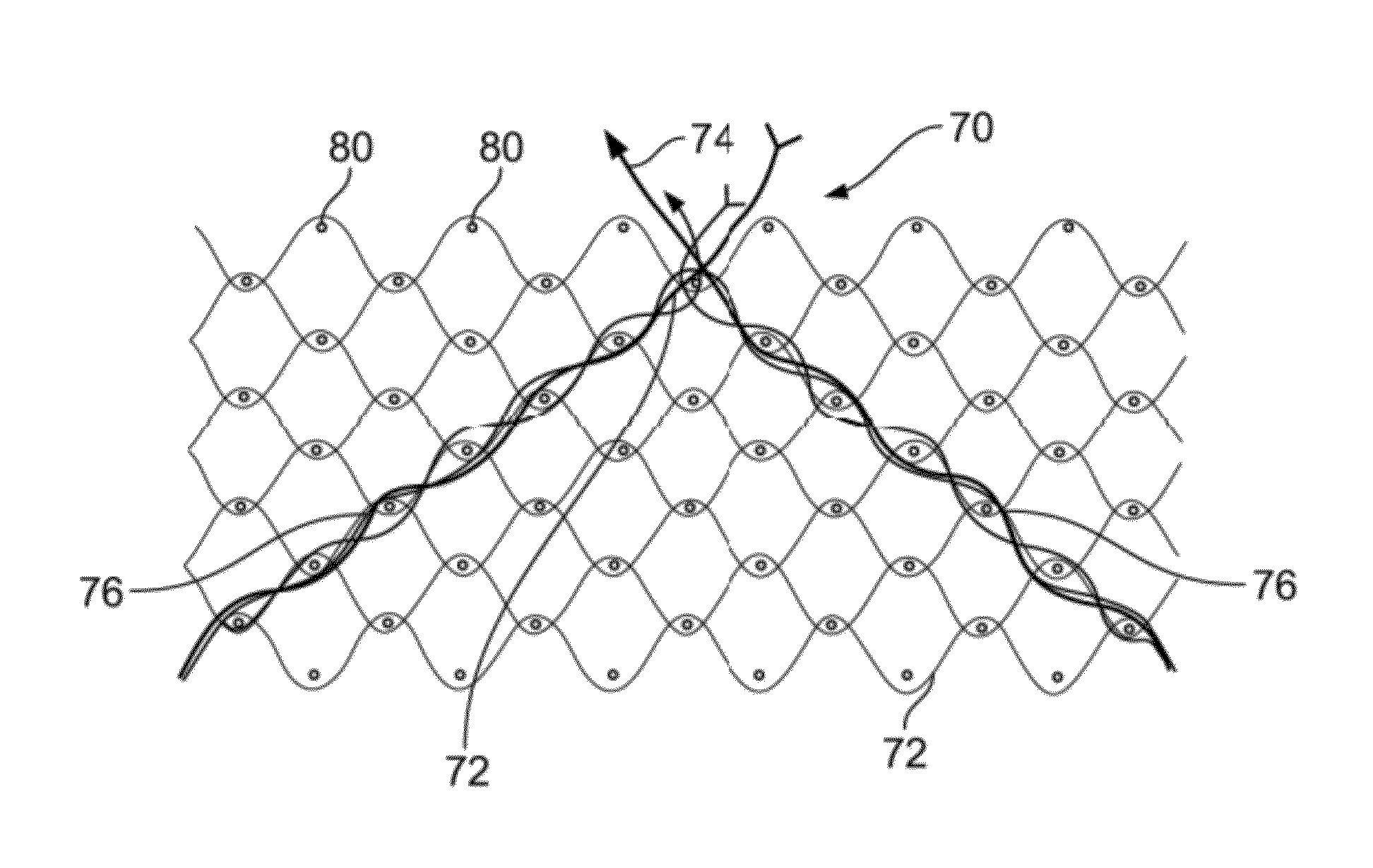 Vascular implants and methods