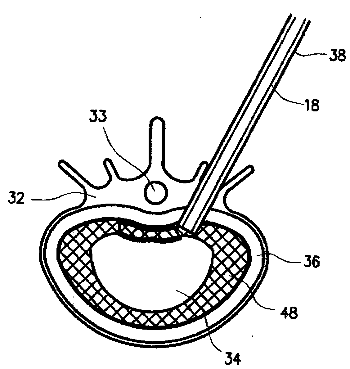 Mechanical apparatus and method for artificial disc replacement