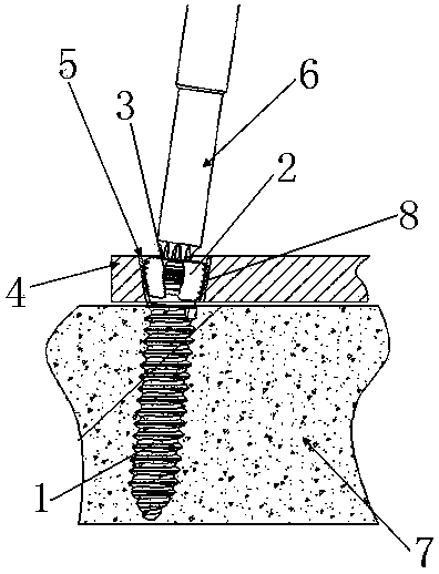 Steel plate screw system with universal locking function