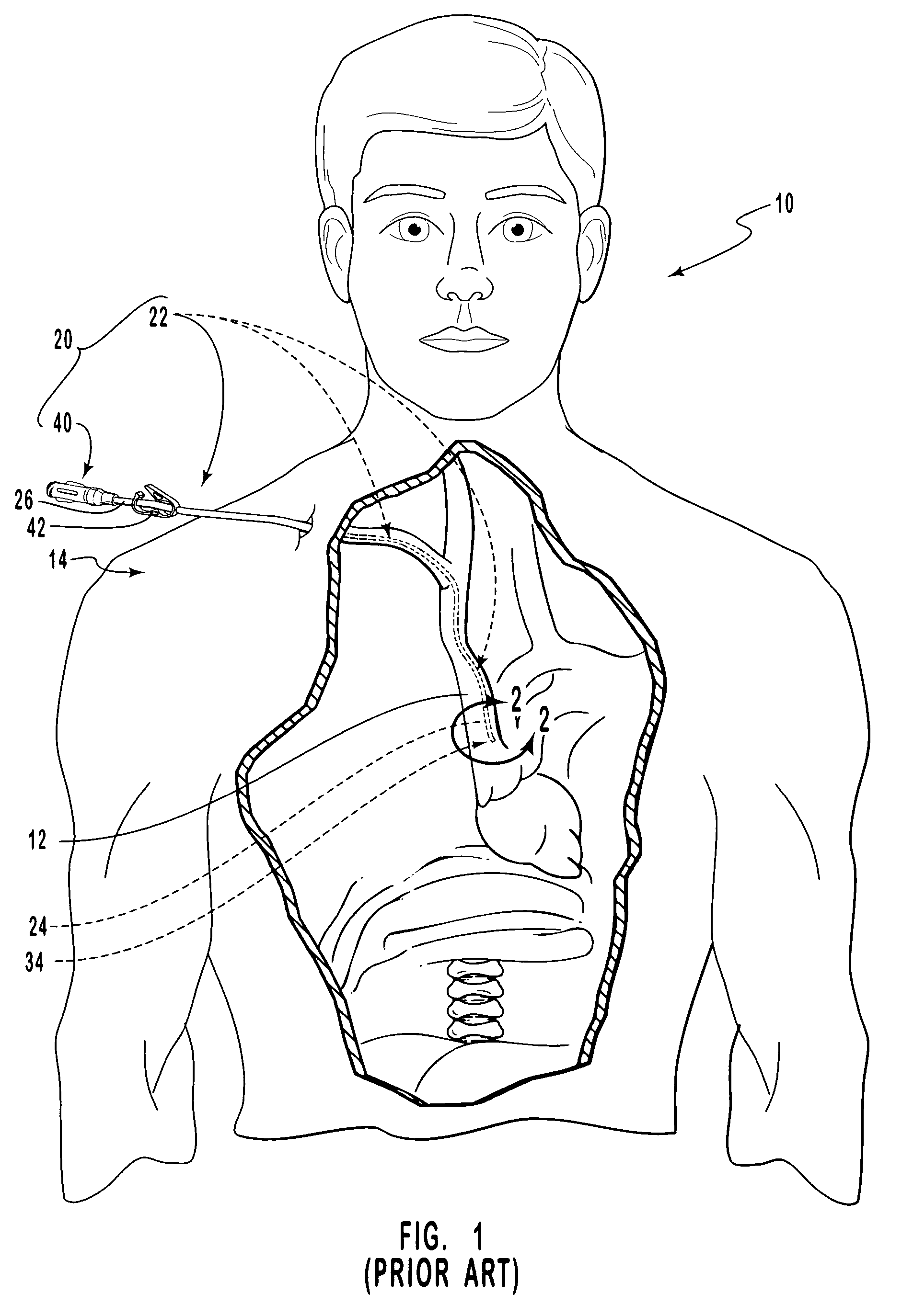 Cardiovascular access catheter with slit valve