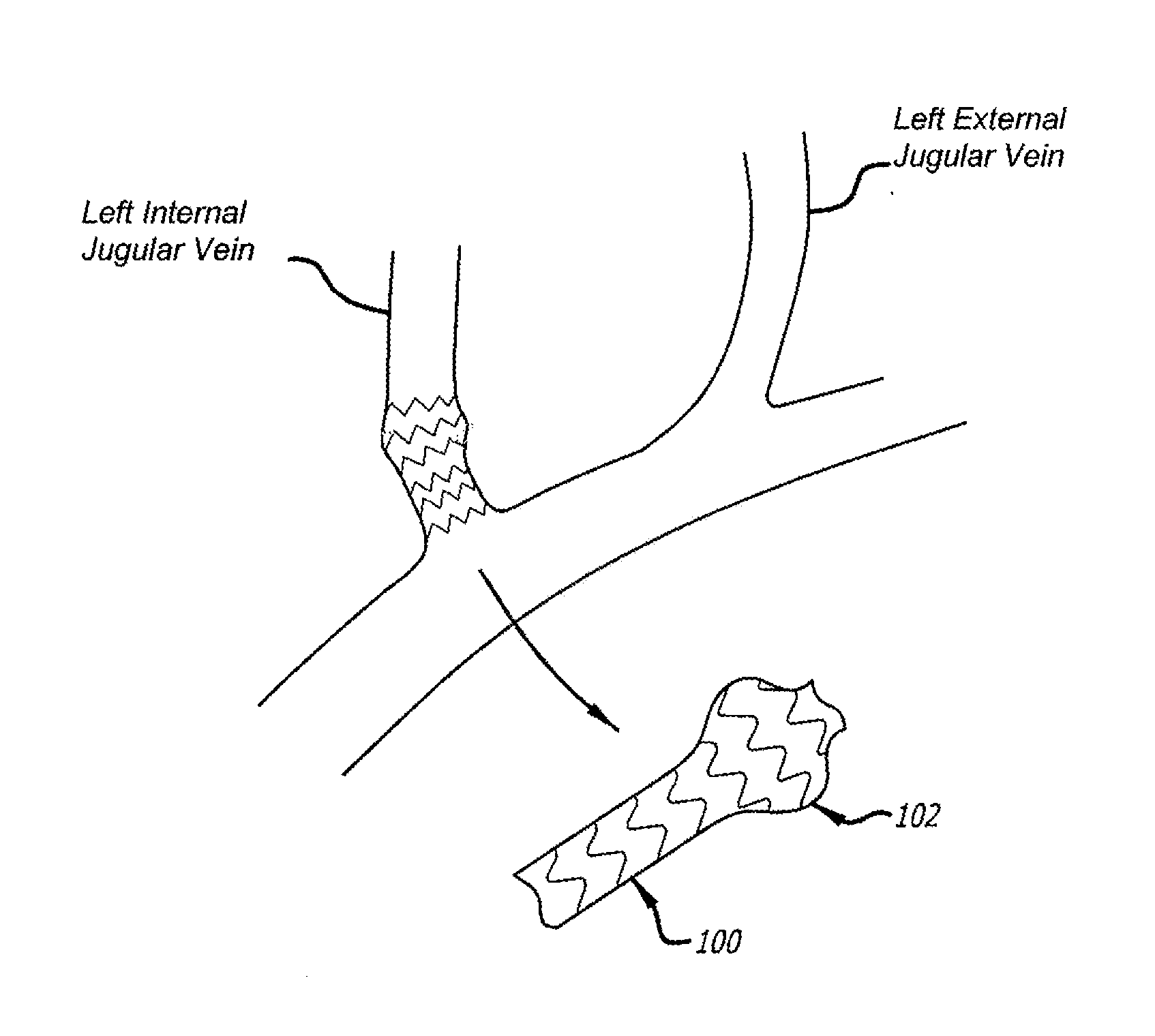 Method of delivering a medical device across a plurality of valves