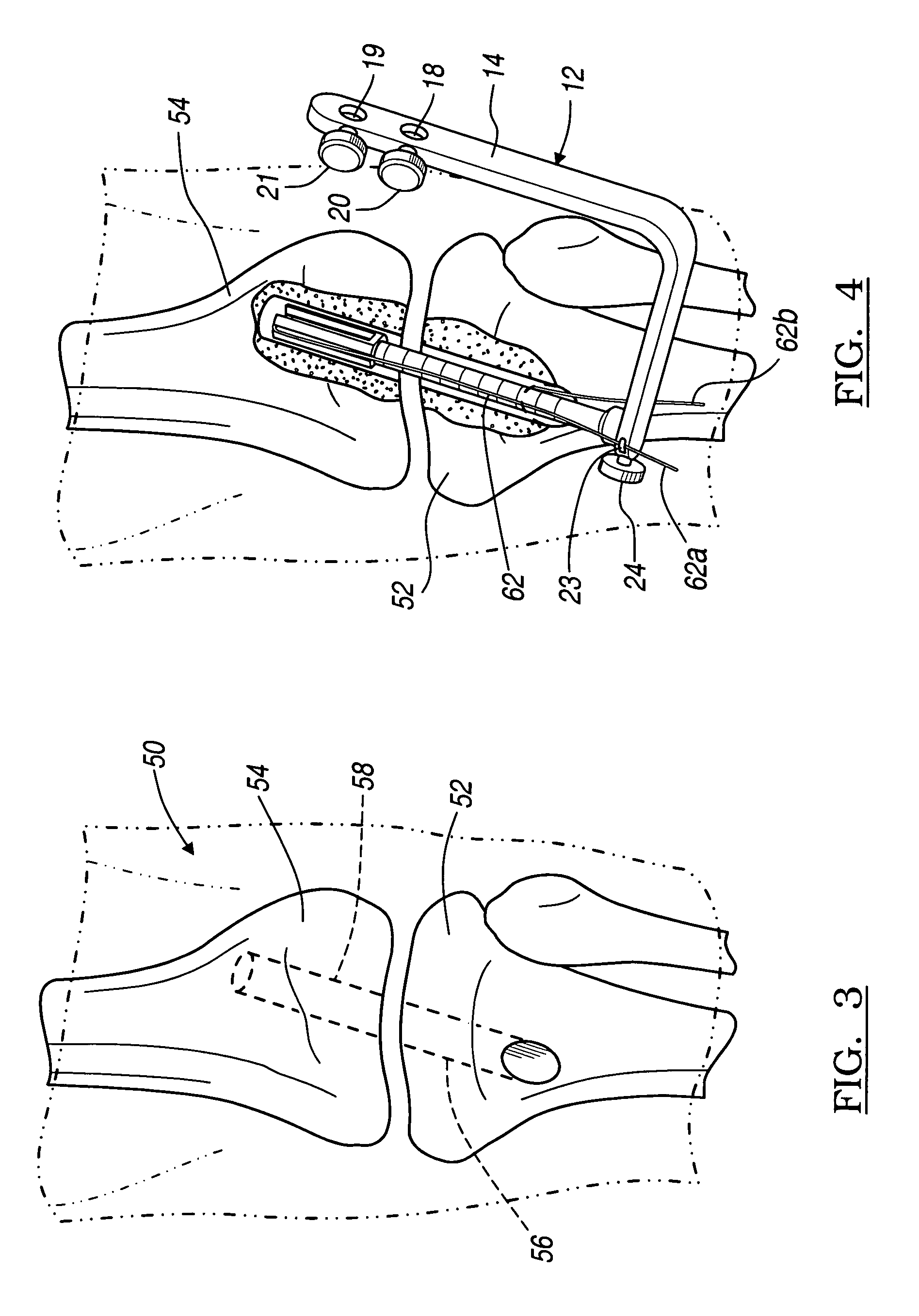 Method and apparatus for graft fixation