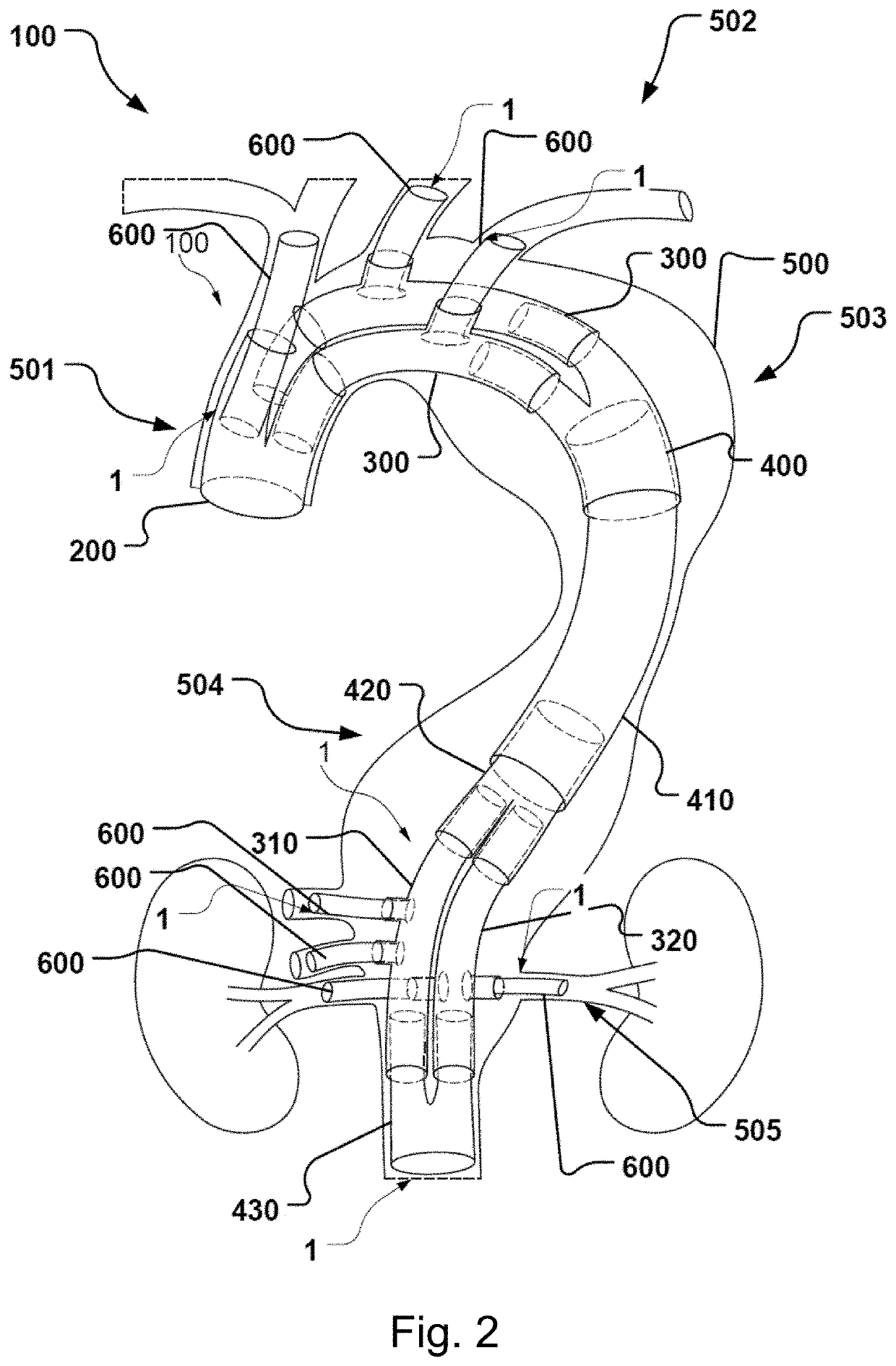 Vascular medical device, system and method