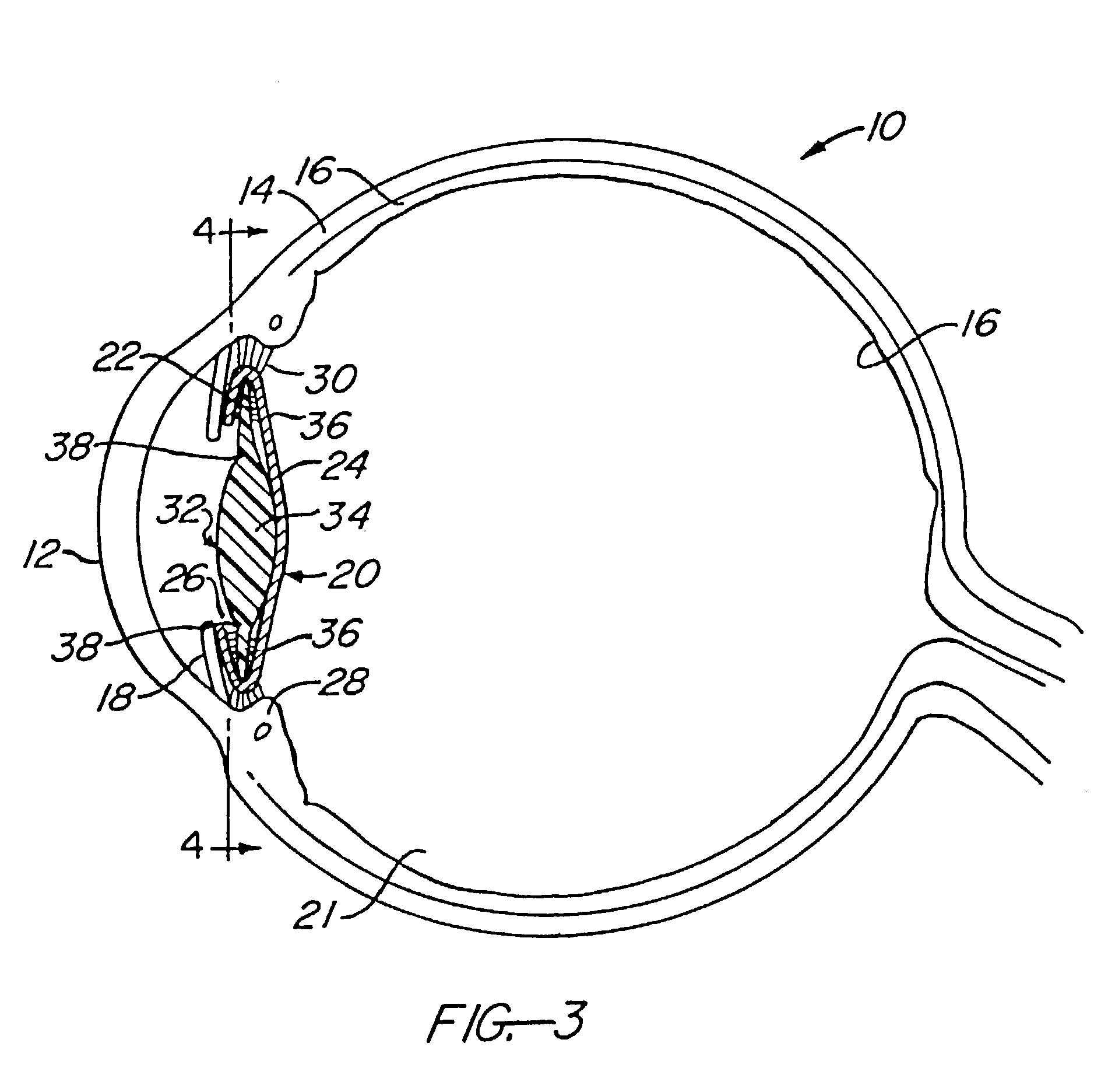 Accommodating intraocular lens having T-shaped haptics