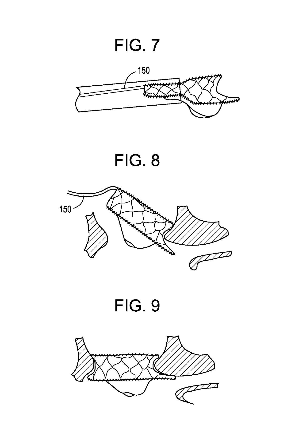 Orthogonally delivered transcatheter heart valve replacement