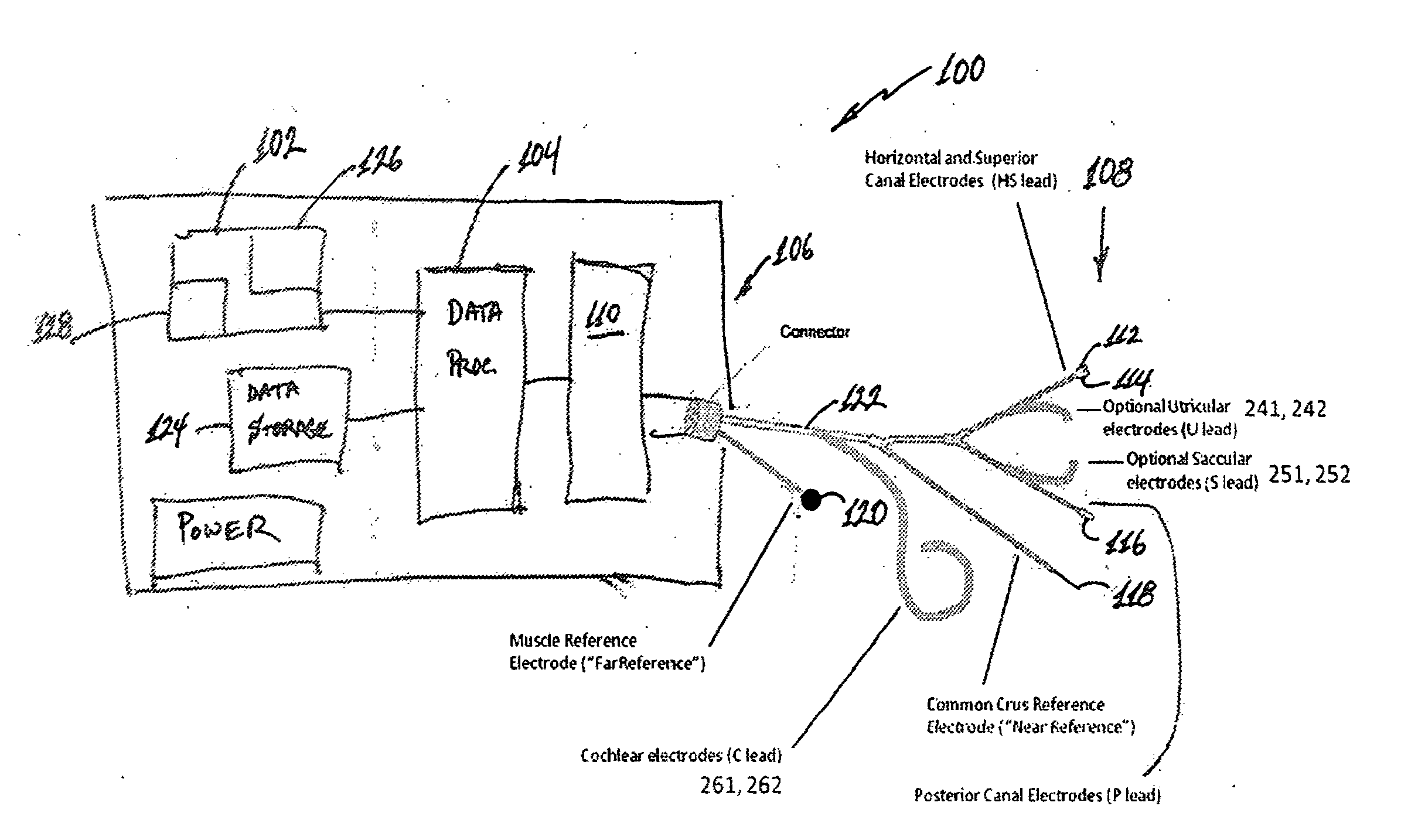 Implantable vestibular prosthesis