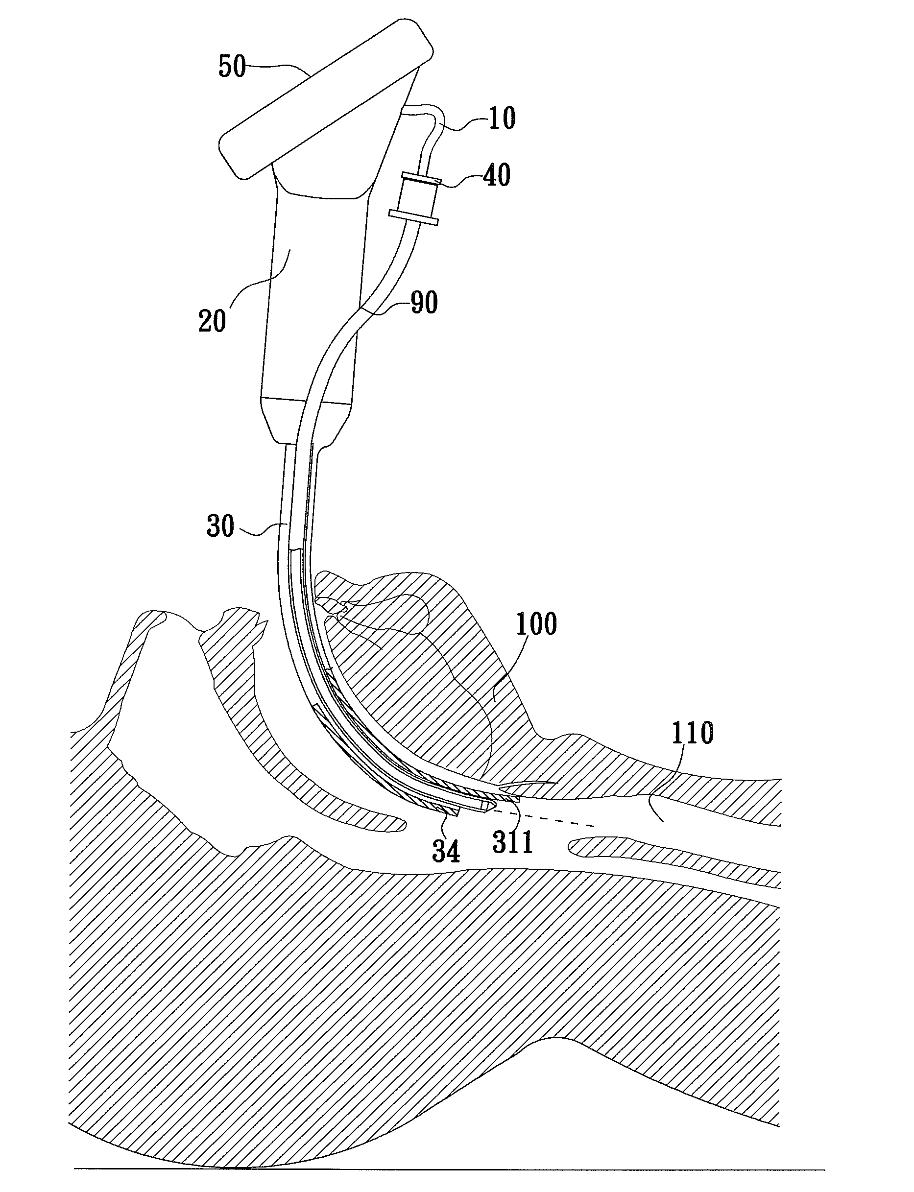 Tracheal Intubation Device