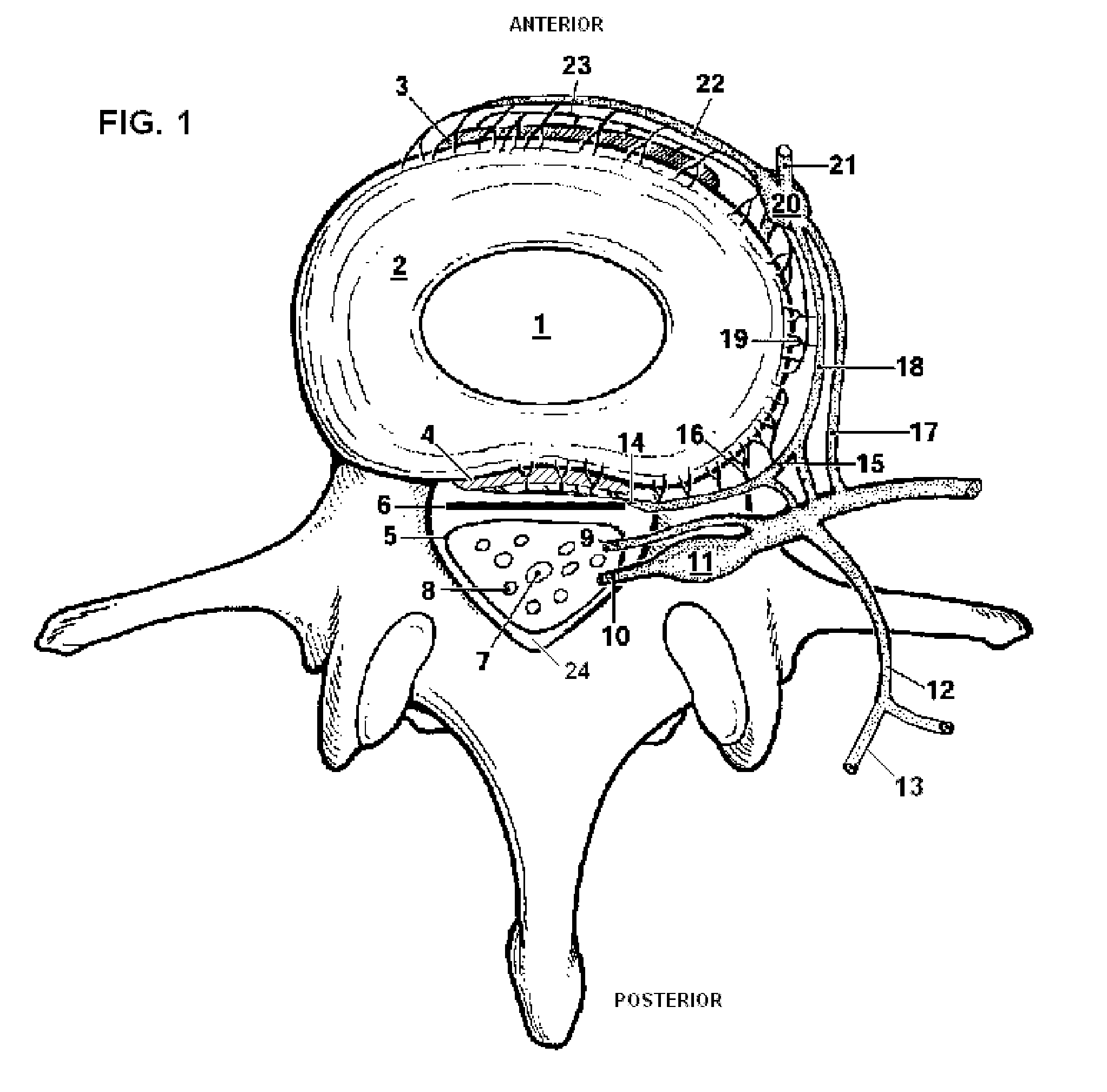 System and Methods for Diagnosis and Treatment of Discogenic Lower Back Pain