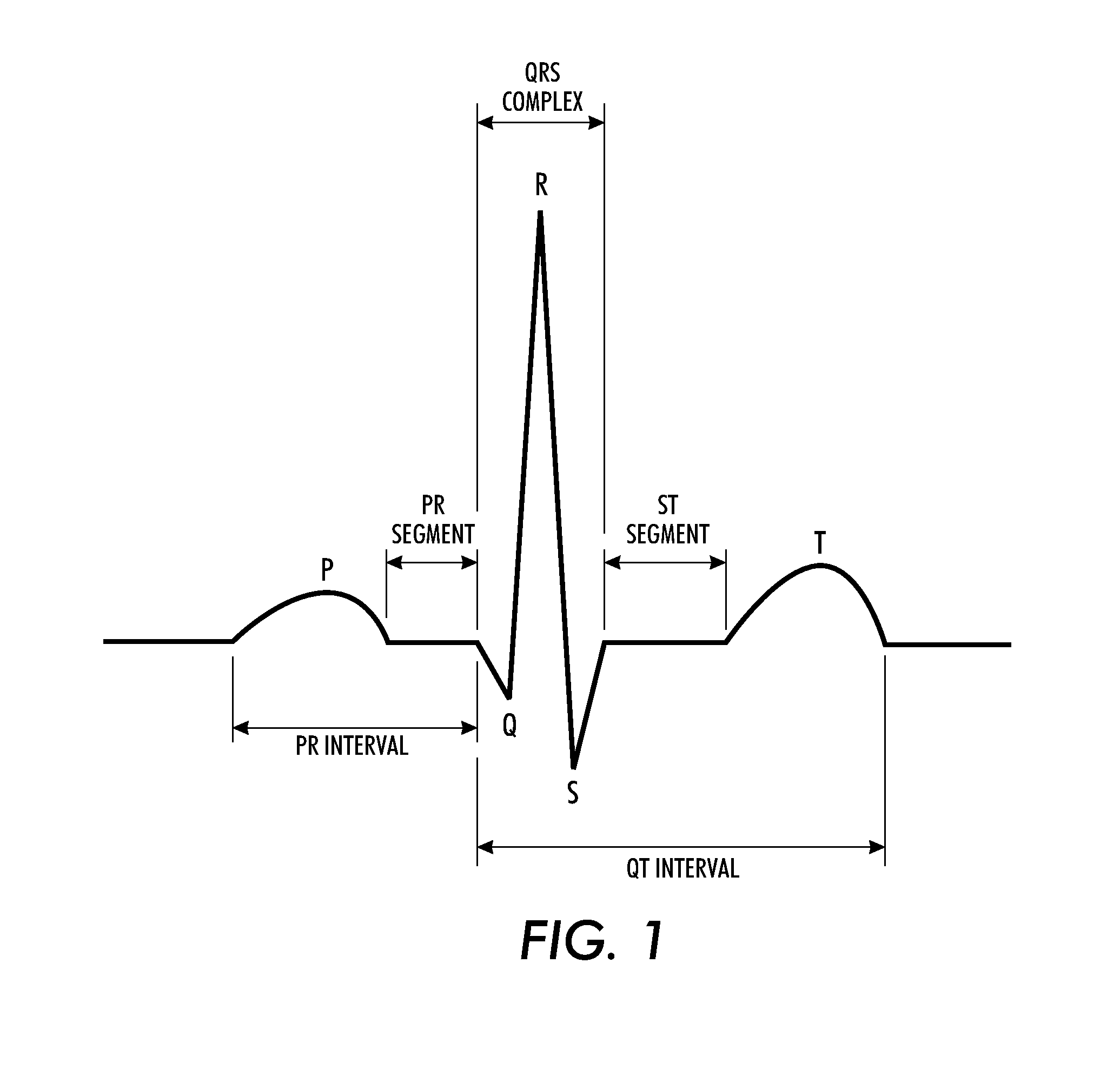 Determining cardiac arrhythmia from a video of a subject being monitored for cardiac function