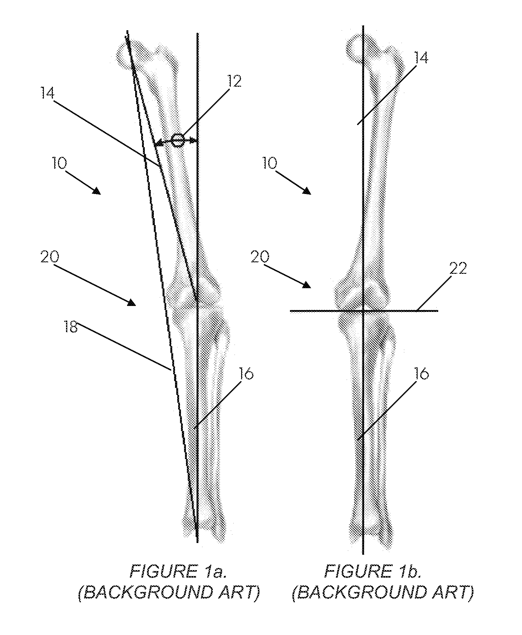 Systems and methods for determining the mechanical axis of a femur