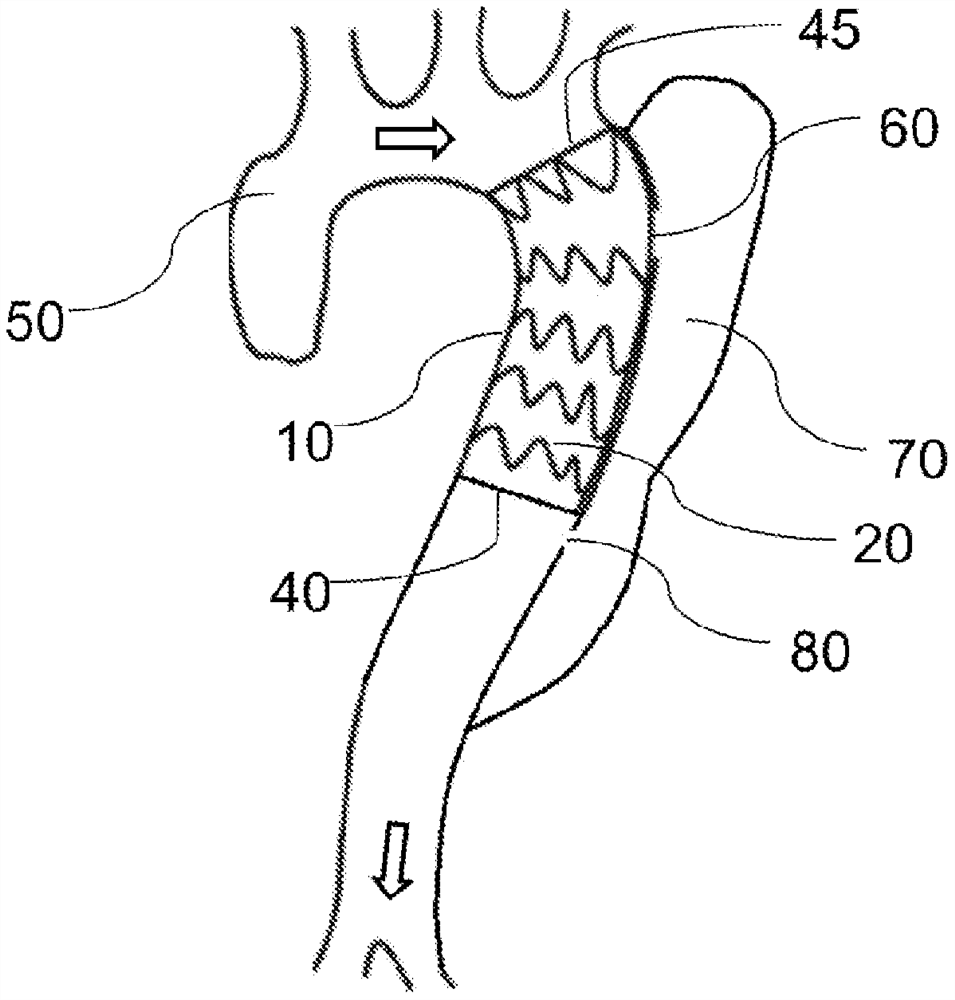 blood catheter with stent