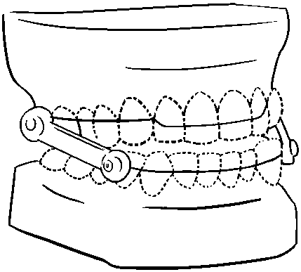 Oriented externally-adjustable snore-ceasing equipment