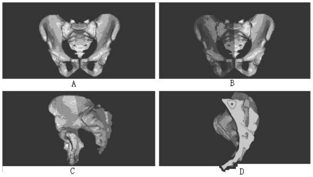 A 3D-printed digital placement method for sacroiliac screws