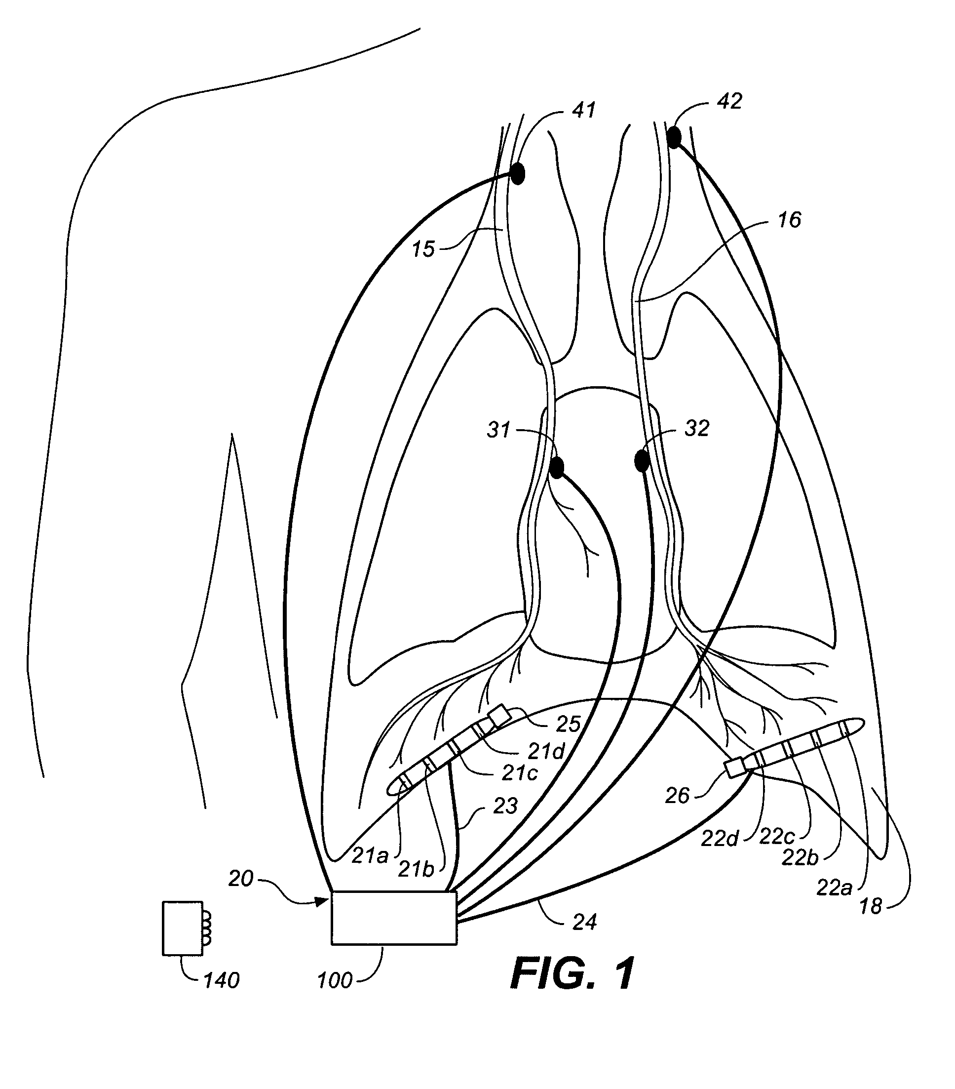 Device and method for treating obstructive sleep apnea