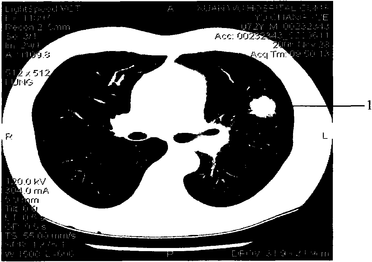 Method for extracting multi-dimensional texture of nodi from medical images