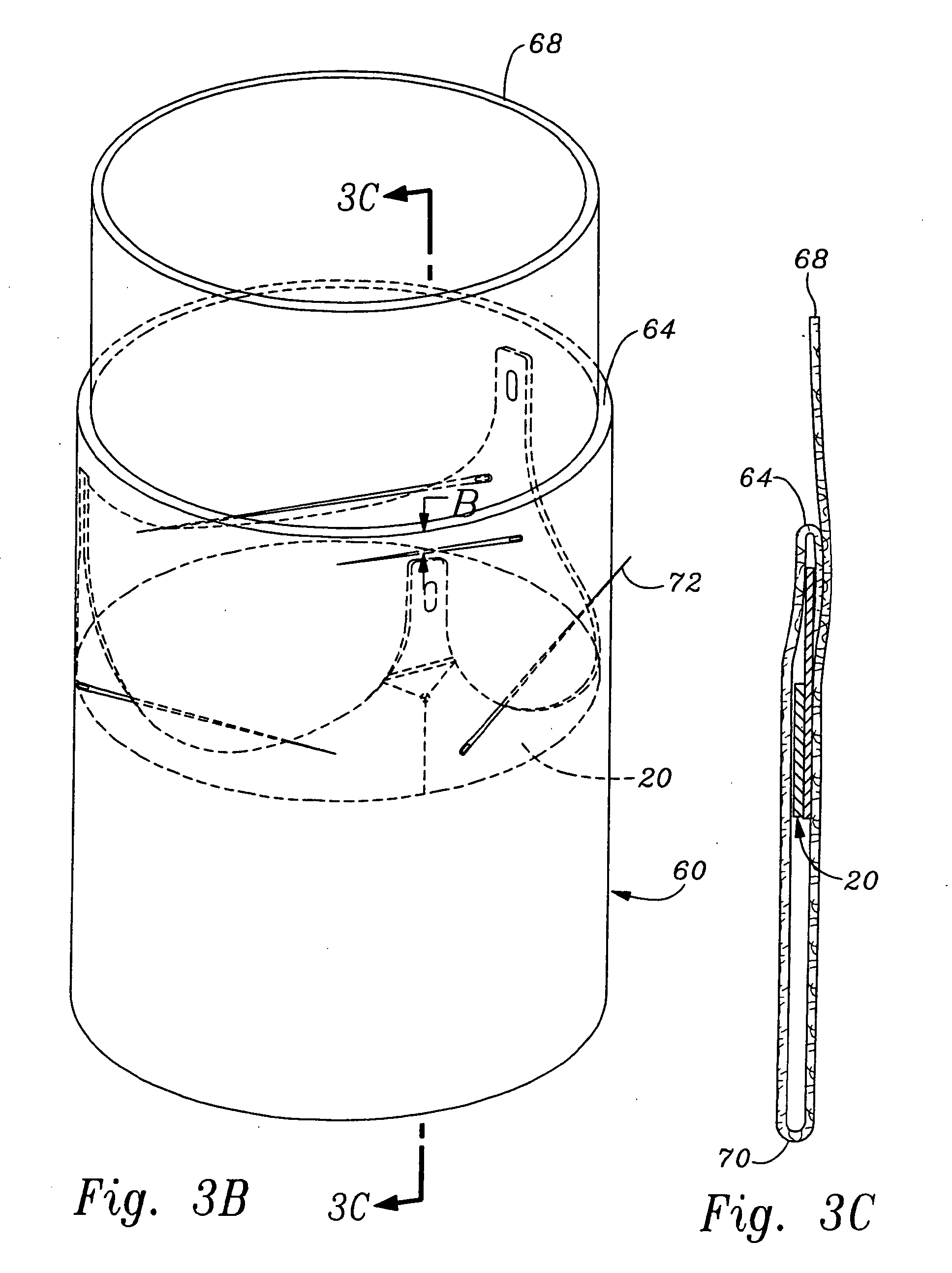 Methods of implant of a heart valve with a convertible sewing ring