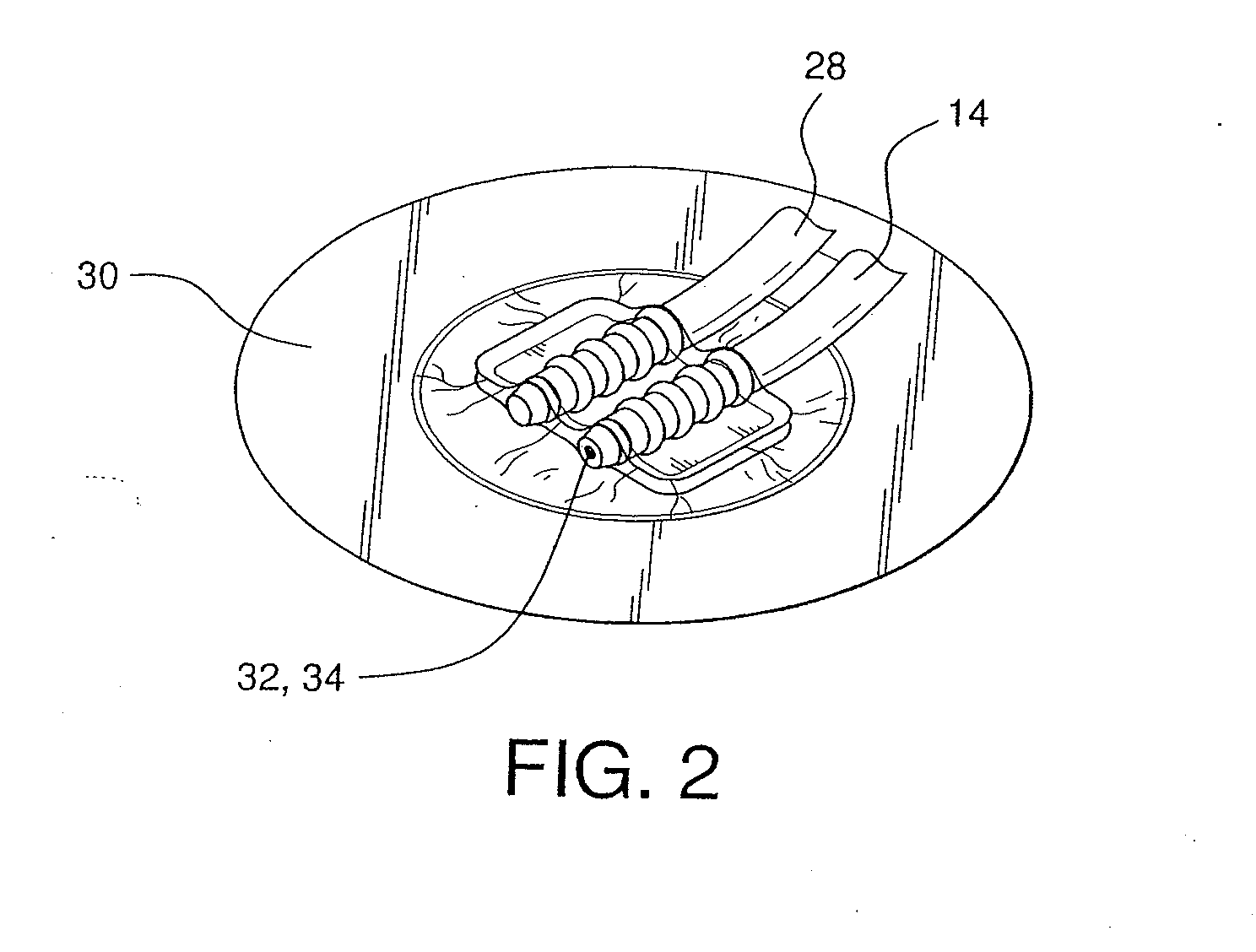 Pump system for negative pressure wound therapy