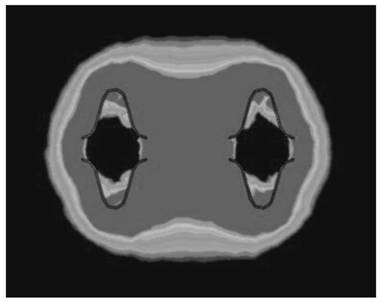 Double-ball-cage electrode catheter device for ablation of tissue in human body cavity