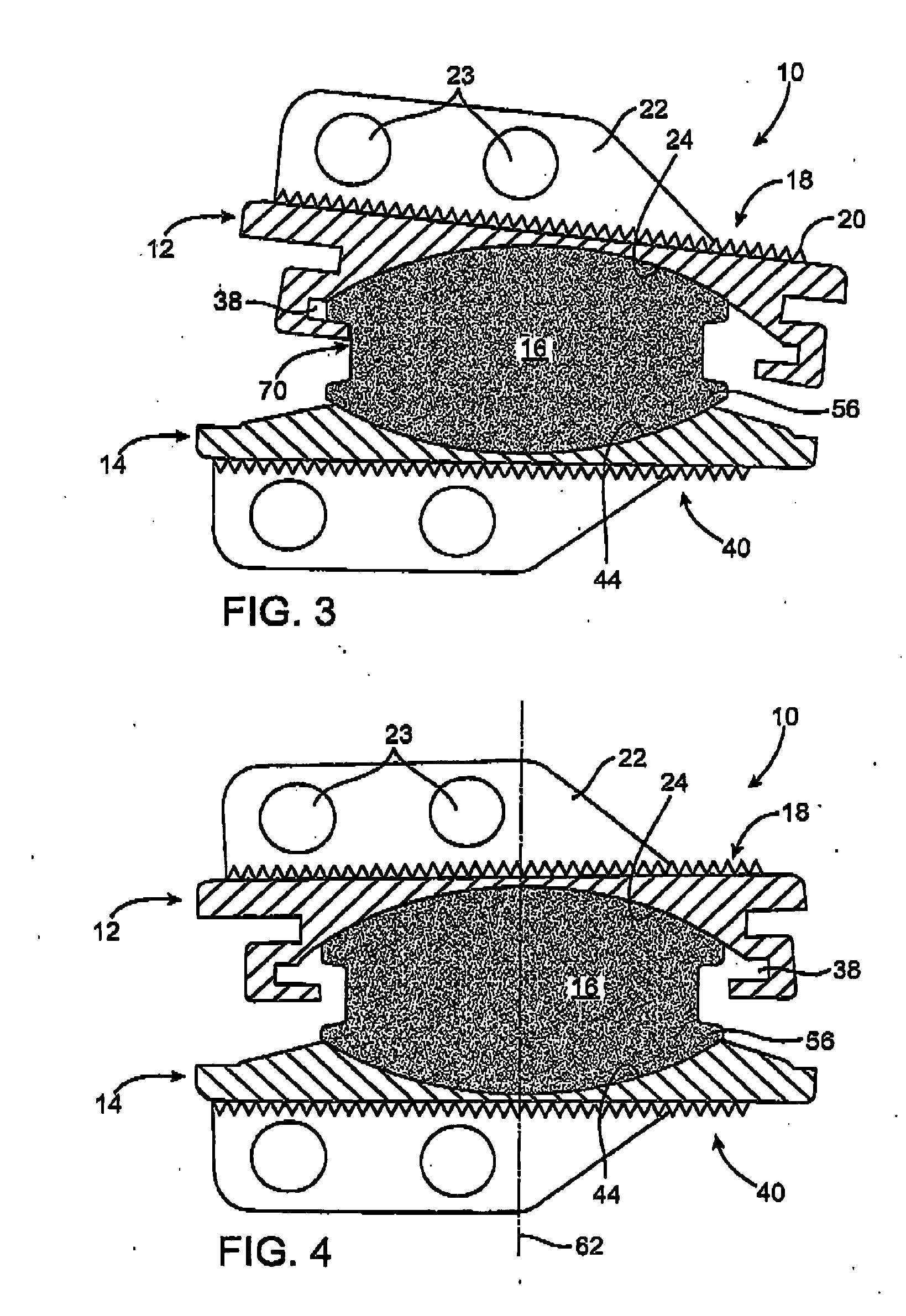 Intervertebral prosthetic disc with metallic core