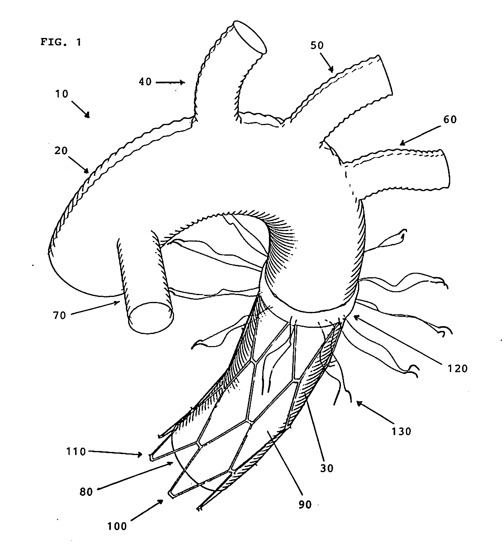 Total aortic arch reconstruction graft