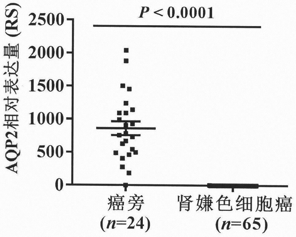 Tumor marker AQUAPORIN2 protein and application thereof