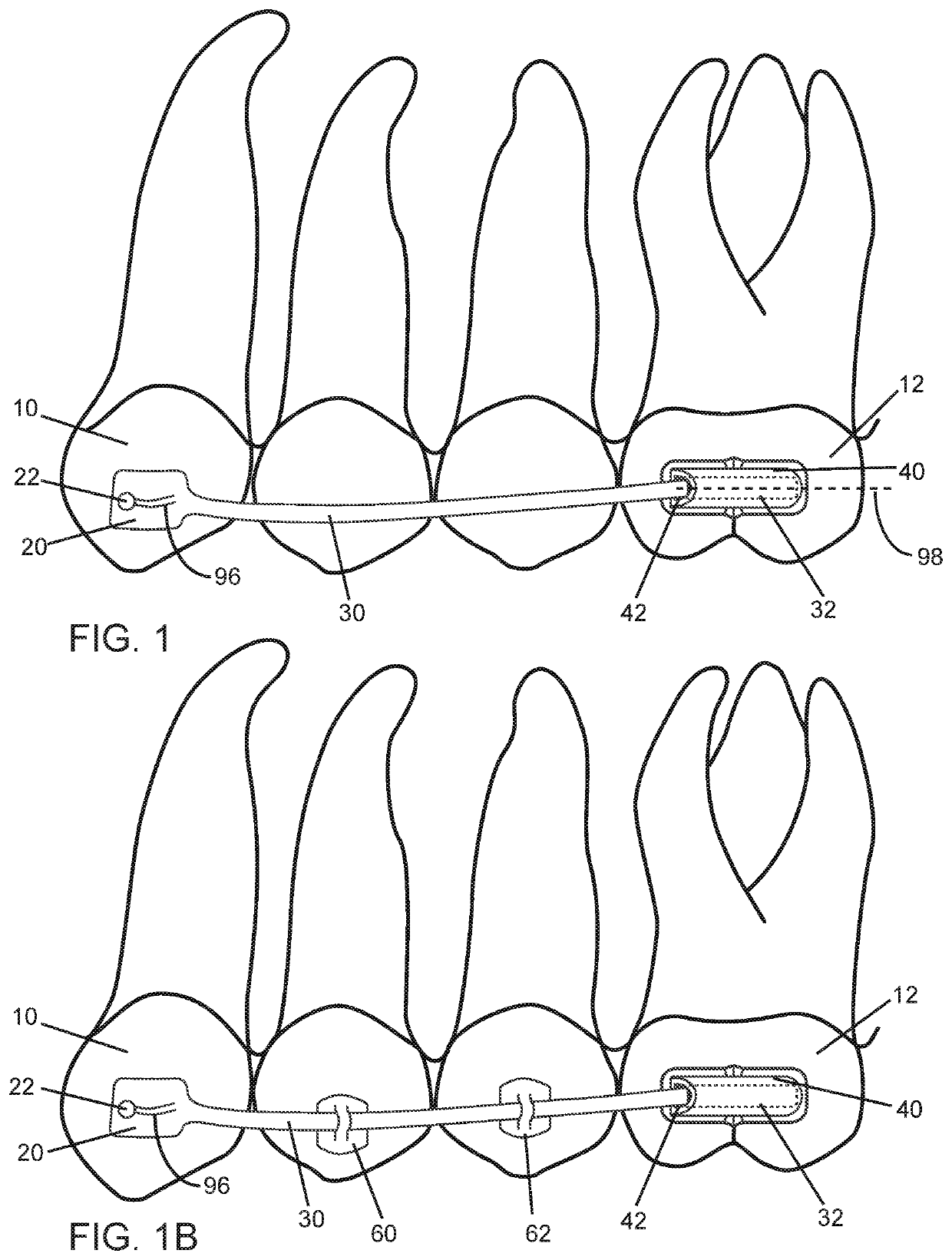 Orthodontic bracket with sliding molar distalizer