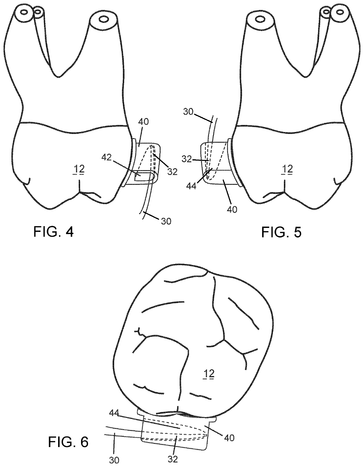 Orthodontic bracket with sliding molar distalizer